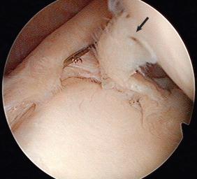 Fig. 44.7, A flap-type superior labrum anterior to posterior lesion. As viewed from the posterior portal, the posterior-based unstable superior labral flap (arrow) can be noted.