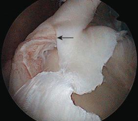 Fig. 44.8, A type IV superior labrum anterior to posterior lesion. The extension of the tear into the substance of the biceps tendon can be seen (arrow) .