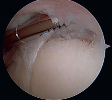 Fig. 44.9, Superior labrum anterior to posterior tear.