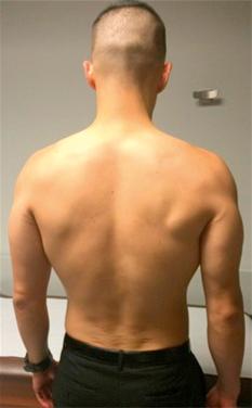 Fig. 42.1, Demonstration of proper attire for a shoulder exam. The exam begins with inspection, looking for side-to-side differences, muscle wasting, etc.