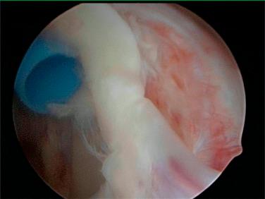 Fig. 42.11, Arthroscopic view looking from the standard posterior portal of a type IV superior labrum anterior posterior tear. Notice the bucket handle tear of the labrum with involvement of the biceps tendon.