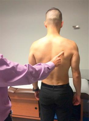 Fig. 42.2, The examiner should specifically palpate and observe the infraspinatus to look for any muscle wasting, which could signify a spinoglenoid notch cyst, or other issues of scapular mechanics or dyskinesia.