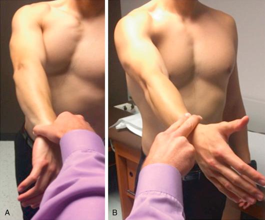 Fig. 42.4, The O’Brien test is performed with the shoulder flexed to 90 degrees and adducted 10–15 degrees. A downward force is applied to the extended forearm with the thumb facing down (A) and up (B). Greater shoulder pain with the thumb facing down than up is a positive test result.