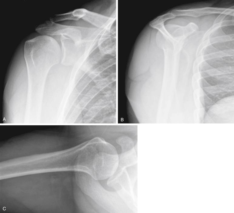 Fig. 42.5, Anteroposterior (A), scapular-Y (B), and axillary (C) views of the shoulder. No significant bony pathology is appreciated on these films.