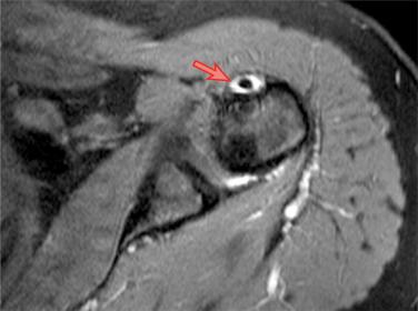 Fig. 42.6, T2-weighted axial magnetic resonance imaging scan of a patient with significant biceps pain. The red arrow demonstrates significant edema surrounding the biceps tendon. This picture would lead the surgeon away from a superior labrum anterior posterior repair and toward a biceps tenodesis.