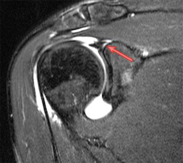 Fig. 42.7, T2-weighted coronal magnetic resonance arthrogram demonstrating fluid extravasation ( red arrow ) underneath the superior labrum, indicating the presence of a superior labrum anterior posterior tear. This finding should be correlated with the patient’s history and physical exam to arrive at an accurate diagnosis.