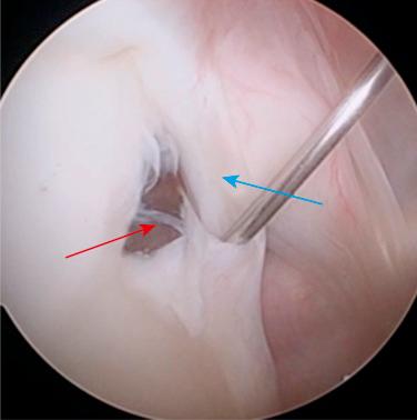 Fig. 42.9, Arthroscopic view looking from the standard posterior portal of a Buford complex. Notice the absence of the anterosuperior labrum ( red arrow ) and the thickened, cordlike middle glenohumeral ligament ( blue arrow ).