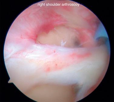 Fig. 42.10, Arthroscopic view looking from the standard posterior portal of a type III superior labrum anterior posterior tear. Notice the bucket-handle tear of the labrum with an intact biceps tendon.