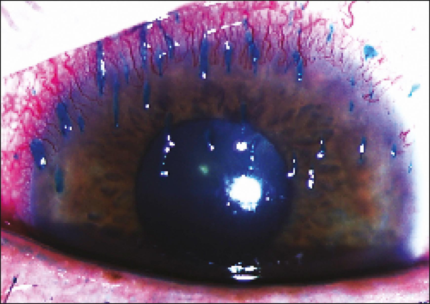 Fig. 48.1, Upper corneal filaments, stained with lissamine green, in a patient with superior limbic keratoconjunctivitis.