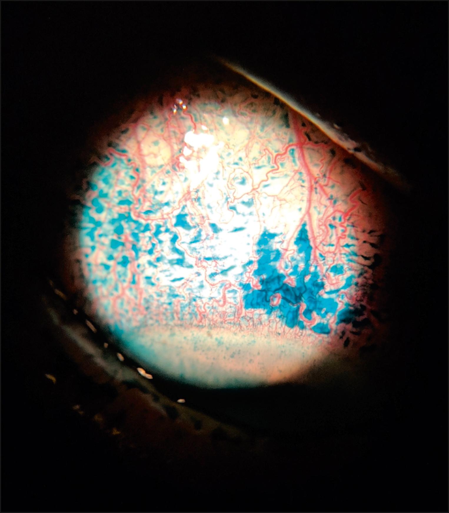 Fig. 48.2, Upper bulbar conjunctiva in a patient with superior limbic keratoconjunctivitis is irritated and injected. Lissamine green staining reveals epithelial defects on this area.