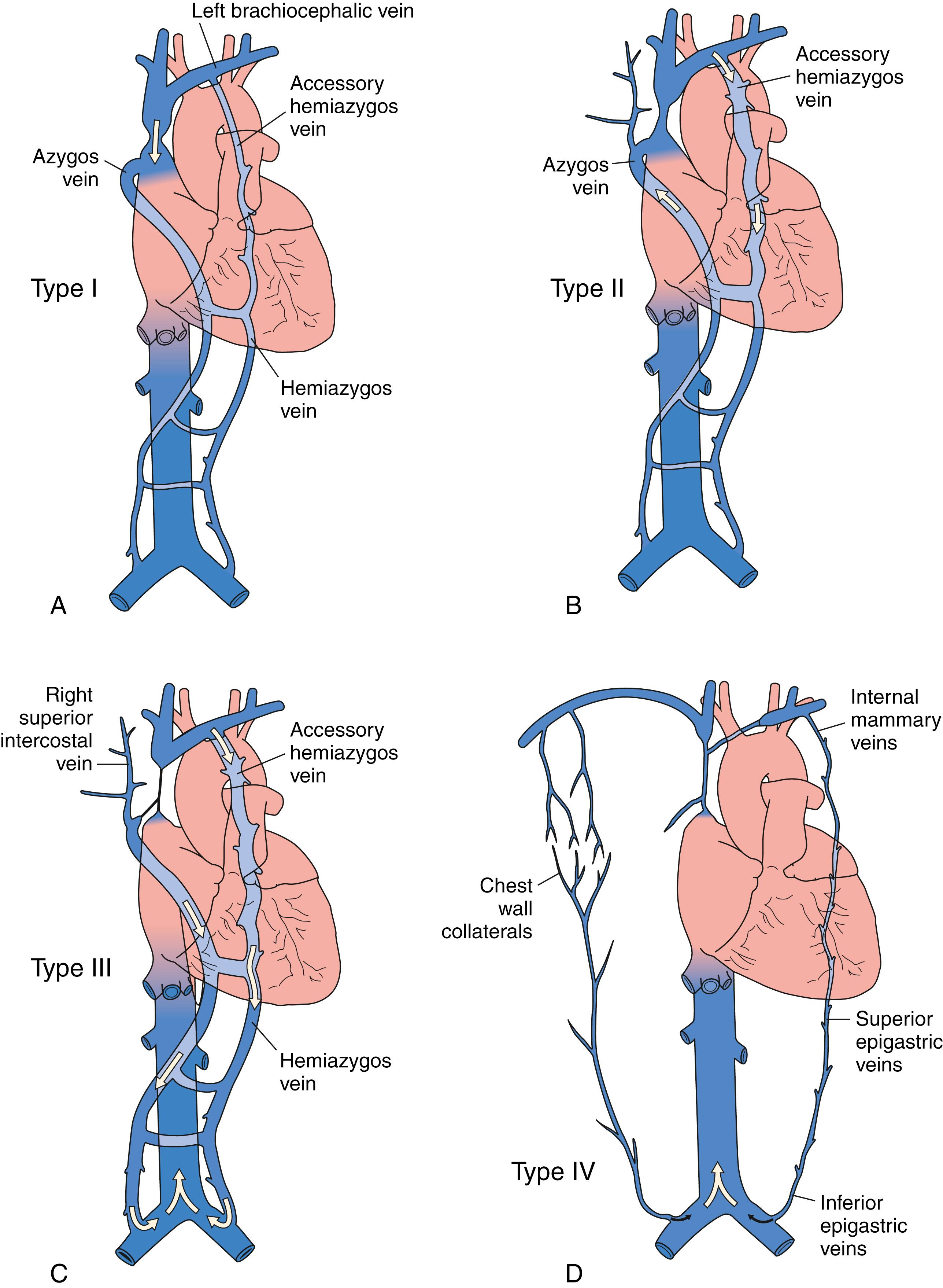 Figure 162.2, Venographic Classification of Superior Vena Cava (SVC) Syndrome According to Stanford and Doty.