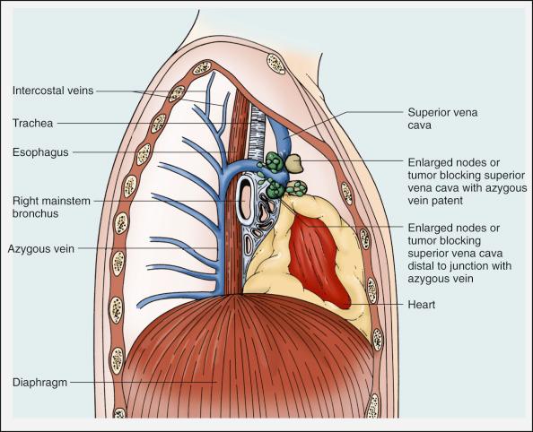 Figure 53.2, Lateral view of the thorax with superior vena cava obstruction.