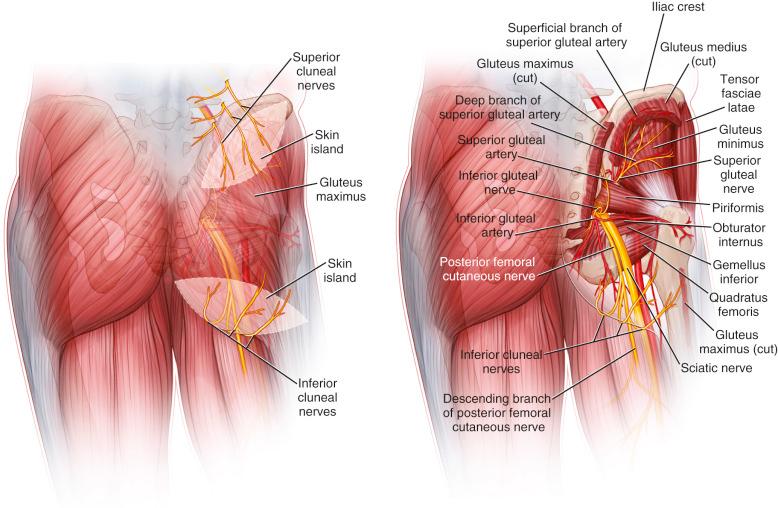 Figure 58.1, Superior and inferior gluteal artery perforator flaps – buttocks.