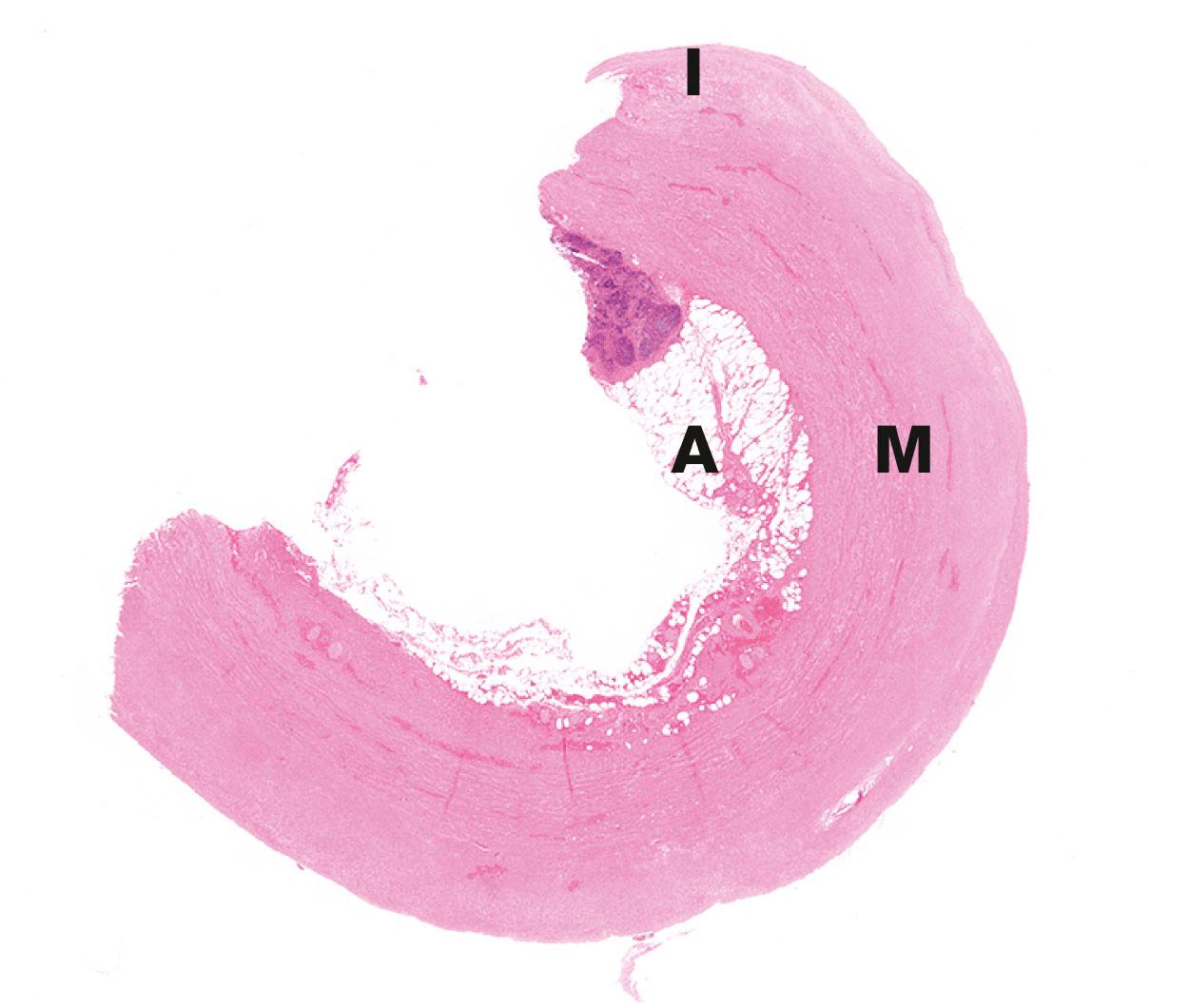 E-Fig. 4.1, Aortic aneurysm (LP)