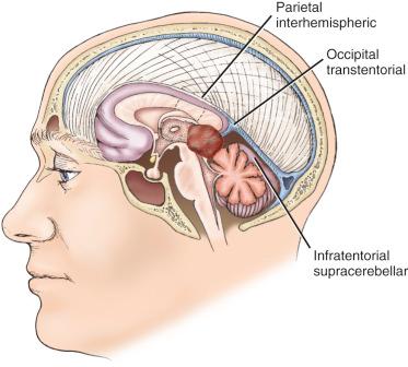 Figure 8.1, Comparison between the occipital transtentorial and the infratentorial supracerebellar approaches to the pineal region. The parietal interhemispheric approach gives access to the lateral and third ventricles.