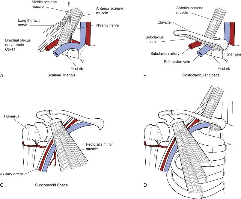 Figure 15-1, Anatomy of the thoracic outlet, focusing on the scalene triangle, the costoclavicular space, and the subcoracoid space. A, The scalene triangle is bounded by the anterior scalene muscle, the middle scalene muscle, and the first rib. The brachial plexus and subclavian artery pass through this space and over the first rib, whereas the subclavian vein passes over the first rib immediately in front of the scalene triangle. B, The costoclavicular space lies between the clavicle and the first rib and is bordered superiorly by the subclavius muscle, medially by the costoclavicular ligament, and posteriorly by the insertion of the anterior scalene muscle tendon on the first rib. The brachial plexus and subclavian artery pass over the first rib behind the costoclavicular space, whereas the subclavian vein passes over the first rib through the front part of the costoclavicular space. C, The subcoracoid space lies inferior to the clavicle and underneath the pectoralis minor muscle tendon, just below its insertion on the coracoid process. All of the structures of the neurovascular bundle pass through this space before reaching the axilla. D, Overview of the anatomy of the thoracic outlet.