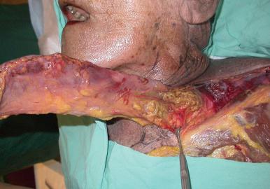 Figure 33.2, Cadaveric dissection of supraclavicular flap. Latex injection shows the supraclavicular artery emanating from the triangle bounded by the SCM, trapezius, and clavicle. Note the axial nature of the vessel within the flap.