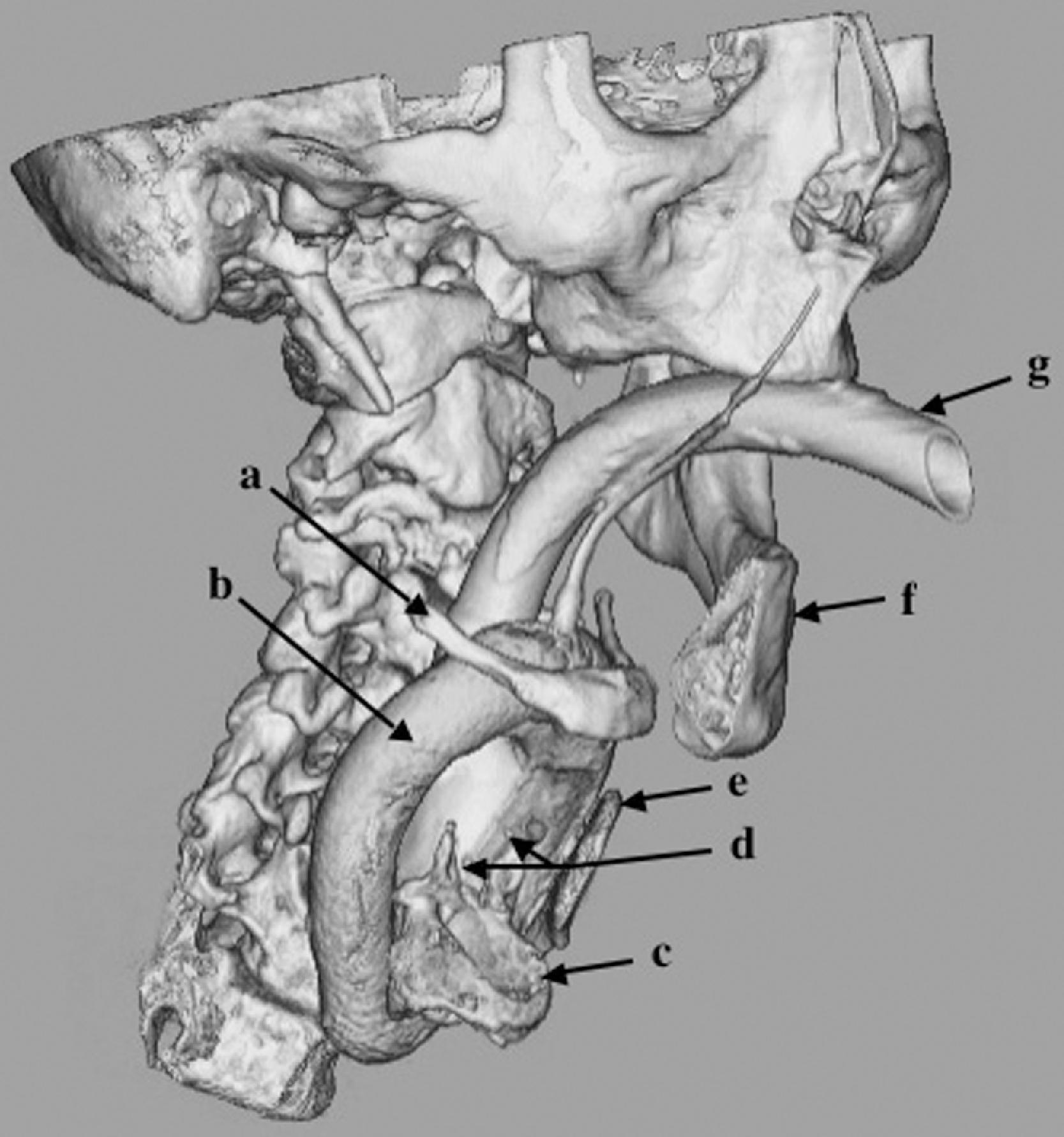 Fig. 19.1, Three-dimensional radiologic reconstruction of the human airway with the laryngeal mask airway (LMA) in situ: hyoid bone (a) ; LMA cuff (b) ; cricoid ring (c) ; arytenoid cartilages (d) ; thyroid cartilage (e) , and mandible (f) , which are digitally partially removed to demonstrate the position of the LMA; and the LMA’s shaft (g) . The LMA cuff forms a seal with the periglottic tissues and provides a continuous connection between the natural airway and the device.