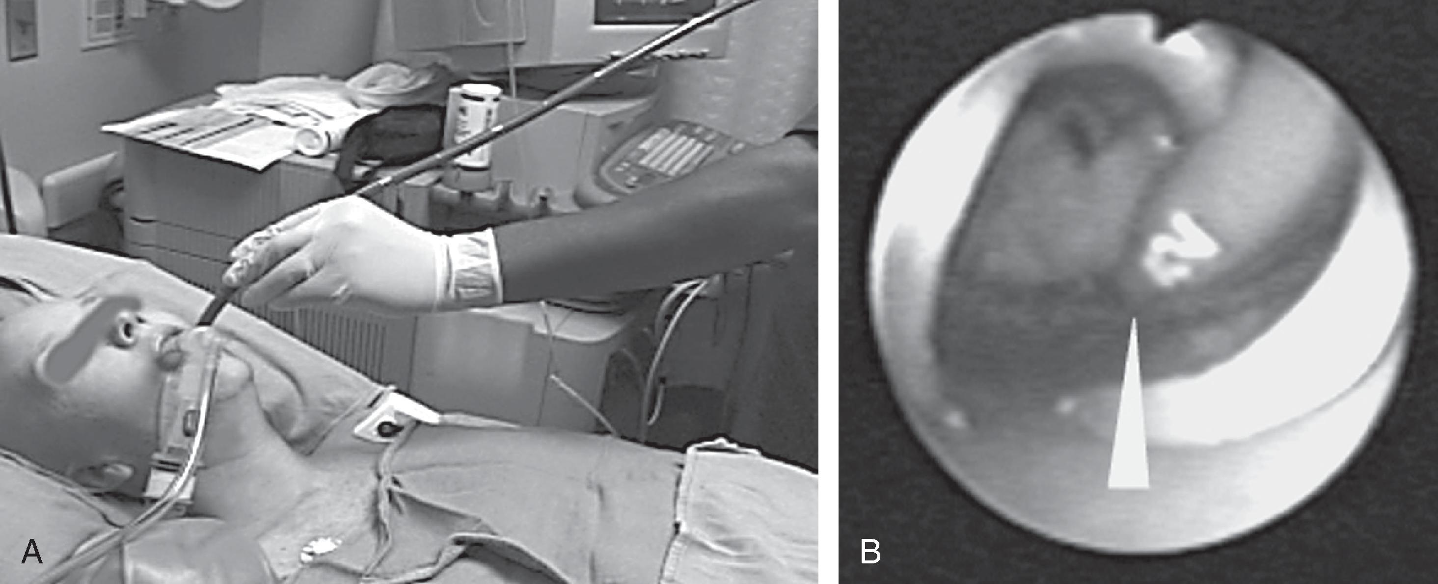 Fig. 19.8, Use of the laryngeal mask airway (LMA) during transesophageal echocardiography (TEE) at the University of Texas M.D. Anderson Cancer Center in Houston. The LMA is inserted after TEE placement. (A) The LMA does not interfere with TEE examination. (B) Flexible scope view through the LMA shows the TEE probe (arrowhead) inside the LMA bowl.