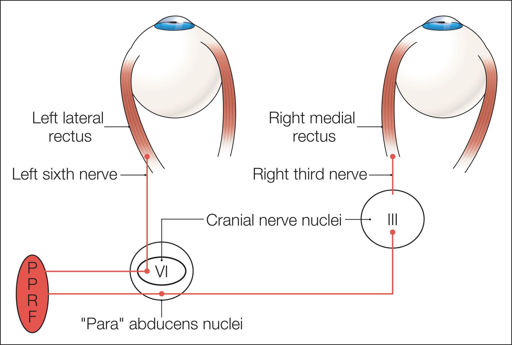 Fig. 91.1, Schematic of brainstem pathways coordinating horizontal saccades. The pontine paramedian reticular formation (PPRF), after receiving input from the ipsilateral cortical centers and superior colliculus, stimulates two sets of neurons in the abducens nucleus: (1) those that send axons to innervate the ipsilateral lateral rectus, and (2) those whose axons join the medial longitudinal fasciculus (MLF) and subsequently activate the medial rectus subnuclei of the contralateral third nerve. III, Third cranial nerve nuclei; VI, sixth cranial nerve nuclei.