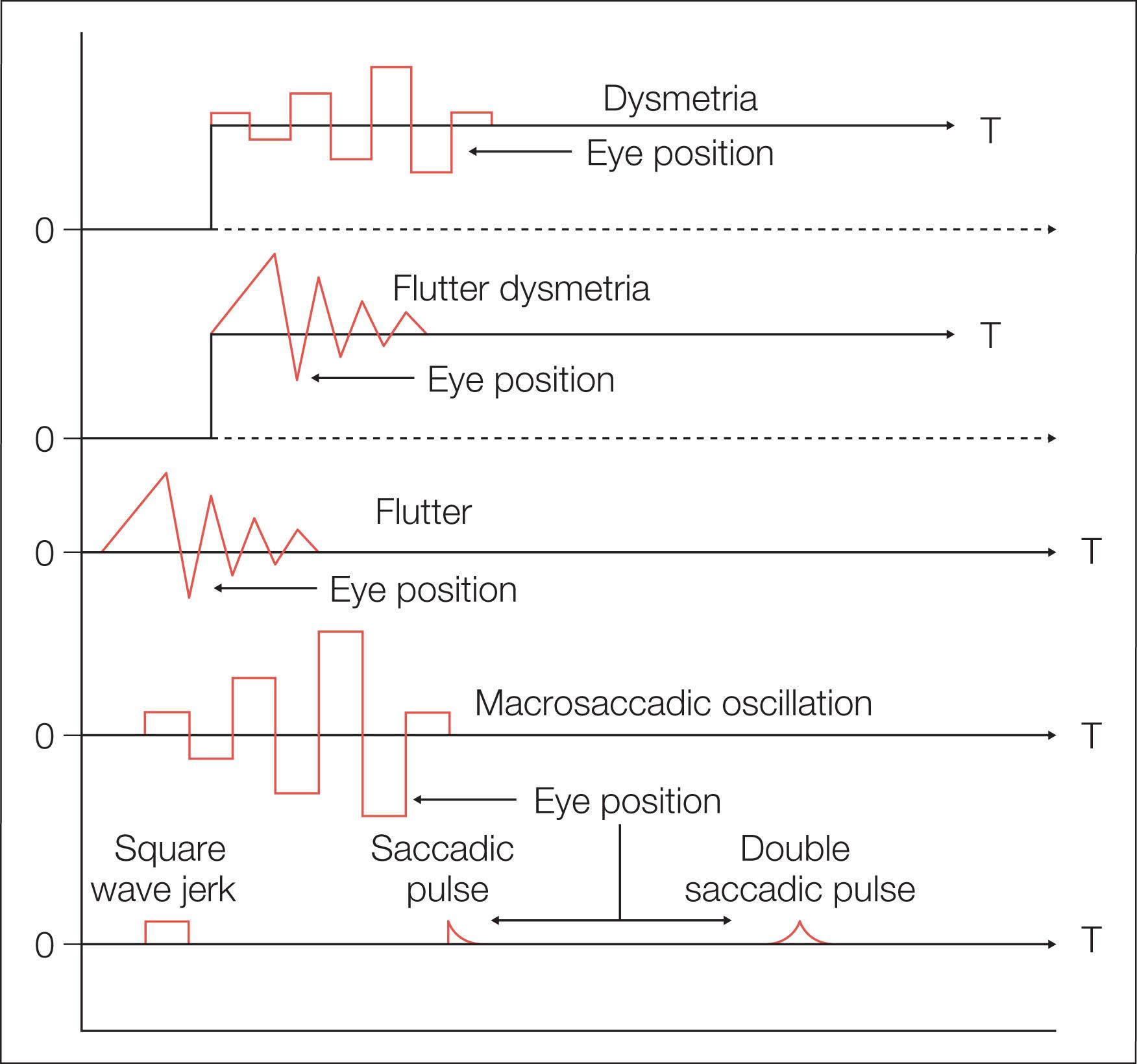 Fig. 91.11, Saccadic intrusions. Artist's representation of major types of saccadic instabilities and their ocular motor characteristics. Continuous periods of time are depicted in each tracing. Rightward eye movements are up and leftward eye movements are down. 0, Primary position fixation; T, target.