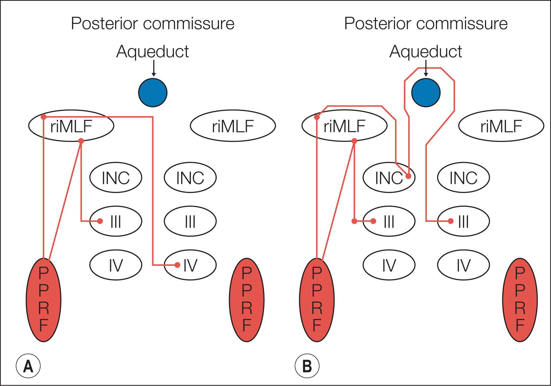 Fig. 91.2, Schematics of brainstem pathways coordinating downward (A) and upward (B) saccades. (A) The pontine paramedian reticular formation (PPRF) activates neurons in the rostral interstitial nucleus of the medial longitudinal fasciculus (riMLF) that send fibers caudally to synapse upon the inferior rectus subnucleus of the ipsilateral third nerve and the contralateral superior oblique nucleus. Not shown in this diagram, fibers from the contralateral PPRF carry corresponding signals simultaneously. (B) The PPRF activates neurons in the riMLF that send fibers through the posterior commissure to the superior rectus subnucleus of the contralateral third nerve and fibers to the inferior oblique subnucleus of the ipsilateral third nerve. Not shown in this diagram, fibers from the contralateral PPRF carry corresponding signals simultaneously. III, Third cranial nerve nucleus; IV, fourth cranial nerve nucleus; INC, interstitial nucleus of Cajal.