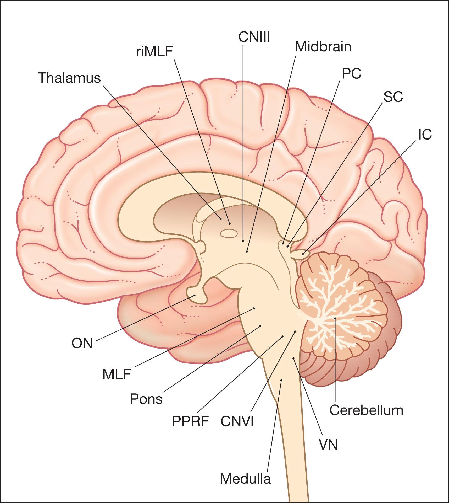 Fig. 91.3, Midline sagittal section of a human brain. Sites within the brain responsible for the “localizing” forms of acquired nystagmus. CNIII, Third cranial nerve nuclei; CNVI, sixth cranial nerve nuclei; IC, inferior colliculus; MLF, medial longitudinal fasciculus; ON, optic nerve; PC, posterior commissure; PPRF, pontine paramedian reticular formation; riMLF, rostral interstitial nucleus of the medial longitudinal fasciculus; SC, superior colliculus; VN, vestibular nucleus.