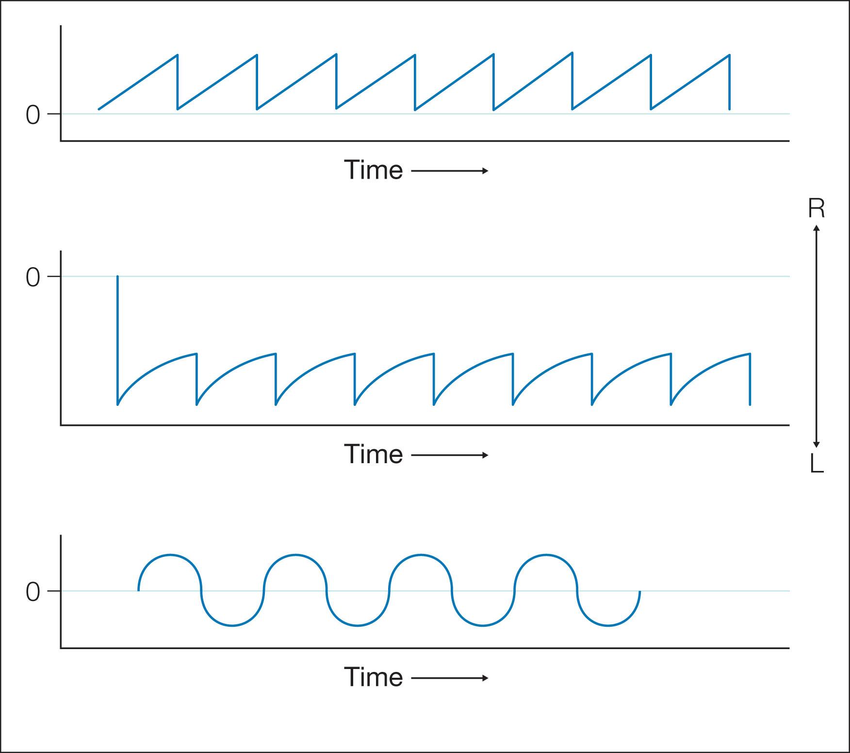 Fig. 91.7, Ocular oscillations. Artist's representation of major types of nystagmus waveforms. Continuous periods of time are depicted in each tracing. Rightward eye movements are up and leftward eye movements are down. The top trace shows pure jerk left nystagmus with linear slow phases to the left interrupting fixation in primary position. The middle trace shows jerk left nystagmus in left gaze with decreasing velocity slow phases. The bottom trace shows pure pendular nystagmus interrupting primary position fixation.