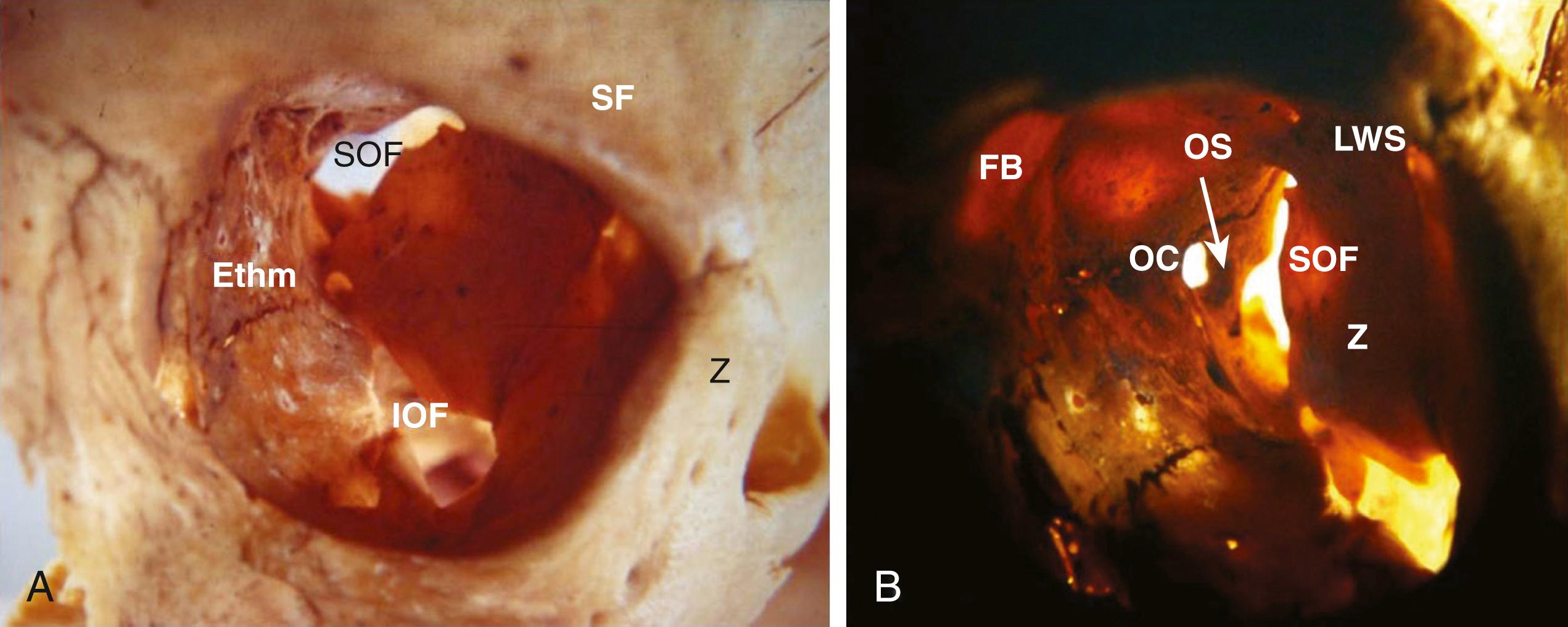 FIGURE 26.1, (A and B) Overview of orbital anatomy. Ethm, Ethmoidal bone; FB, frontal bone; IOF, inferior orbital fissure; LWS, lesser wing of sphenoid; OC, optic canal; OS, optic strut; SF, supraorbital foramen; SOF, superior orbital fissure.