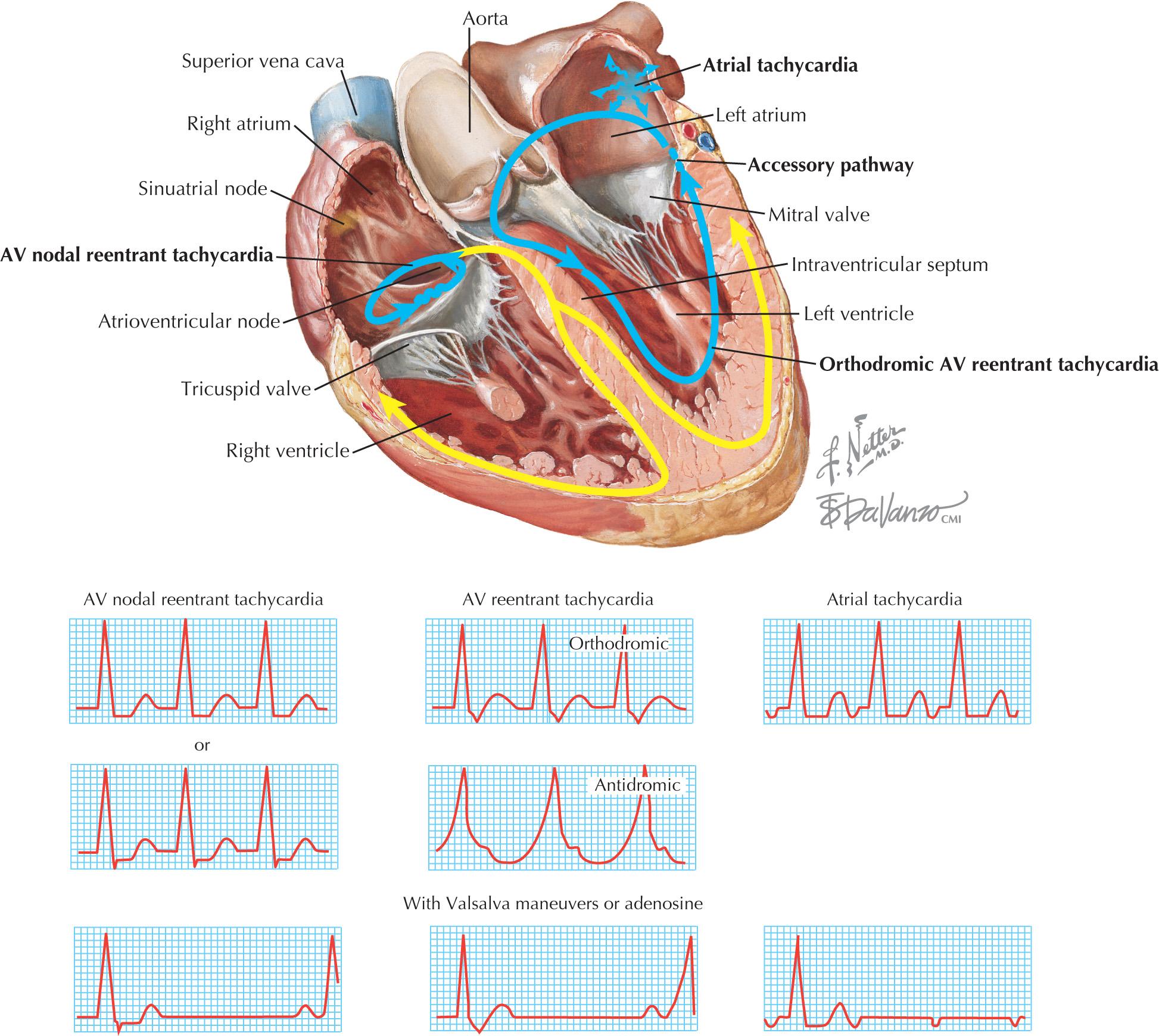 FIG 37.3, Typical ECG Recordings of the Most Common Forms of Supraventricular Tachycardia.