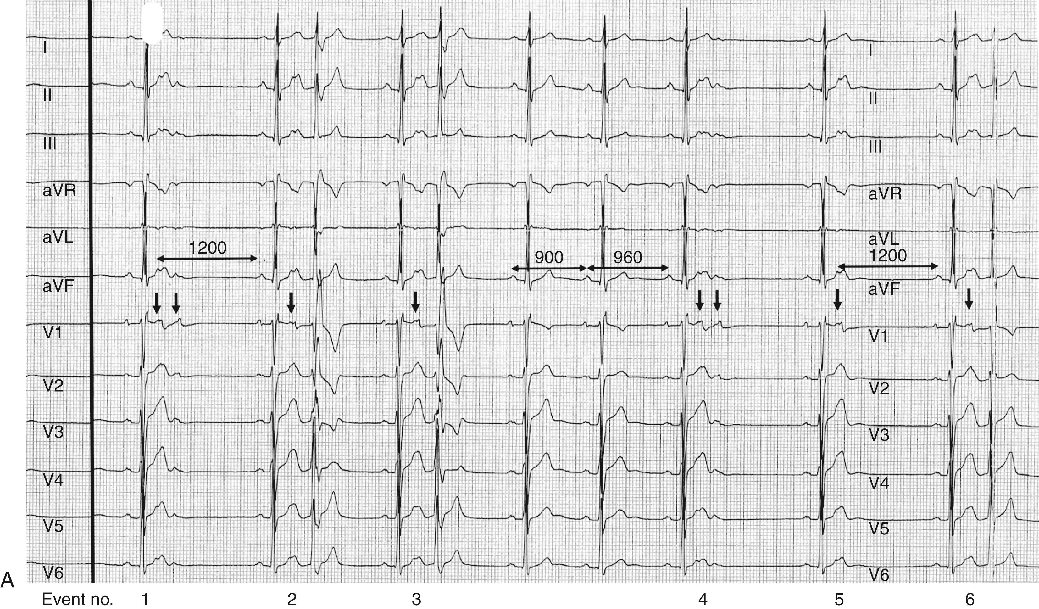 FIGURE 65.1, A, Continuous 12-lead ECG with frequent atrial ectopics. Events 1 and 4 demonstrate 2 atrial ectopic beats in quick succession; the first is inscribed within the initial component of the T wave and the P wave morphology is obscured. The second occurs immediately after the T wave, and the morphology is very different from the sinus morphology. This is particularly evident in lead III and V 1 . Neither of these two ectopics in event 1 or 4 are conducted, creating the appearance of an unexpected sinus pause. Similarly, event 5 has a single ectopic beat inscribed within the T wave, which is nonconducted and also creates an apparently unexpected pause. Close inspection of the T wave immediately before the pause clearly demonstrates the mechanism. The pause duration from ectopic to next sinus beat (1200 msec) is longer than a single sinus interval (900 msec). This longer interval includes the conduction time into the node, depolarization and reset of the node possibly with overdrive suppression, and then conduction out from the node (sinoatrial conduction time). Note that in event 1 the pause from first ectopic to the following sinus beat is also 1200 msec, indicating that the second ectopic beat has not resulted in further sinus node reset. This is presumably because the perinodal region was refractory as a result of the immediately preceding ectopic. In events 2, 3, and 6, the ectopic is conducted with a prolonged PR interval as the early ectopic is conducted to the AV node while still relatively refractory and therefore decremental or slow conduction occurs. The QRS complex in these conducted beats demonstrates right bundle branch block aberrancy. The long preceding interval produced by the pause is followed by a short interval, which renders the right bundle branch refractory at that moment. Note that the right bundle branch has a longer refractory period than that of the left bundle branch. B, Continuous 3-lead rhythm strip with high burden of atrial ectopics. In events 1, 2, 7, and 8, the ectopic beat is conducted with a long PR interval and right bundle branch aberrancy. In events 3, 4, and 5 there is a nonconducted atrial ectopic beat occurring within the T wave, creating a pause. The bigeminal pattern of atrial ectopy therefore creates the impression of a marked sinus bradycardia with apparent sinus interval of 1440 msec. In event 5, a second atrial premature beat occurs immediately after the T wave and the visible morphology indicates that this is different from the sinus morphology (best appreciated in aVF). Event 6 is the only normal T wave appearance because there is no inscribed atrial ectopic ( downward pointing arrow ) . The sinus interval following the absence of an atrial premature beat is 920 msec rather than the apparent interval of 1440 msec. The interval between the nonconducted atrial premature beat and the following sinus beat (1080 msec) is longer than the sinus interval of 920 msec. C, Continuous three-lead ECG in event 1, an atrial premature beat that conducts with a long PR interval and right bundle branch block (RBBB) aberrancy. In events 2, 3, 4, and 5 there are short (variable duration) runs of nonsustained atrial tachycardia. Again we see conduction with a long PR interval and some beats showing RBBB aberrancy. In event 3 the P wave preceding each QRS complex can be clearly seen when examining both aVF and V 2 ( arrows ) . This constellation of arrhythmias is frequently observed on monitoring in patients with paroxysmal atrial fibrillation.