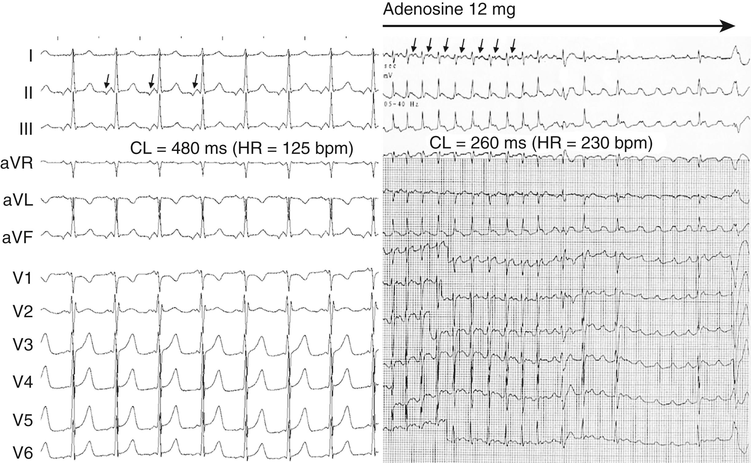 FIGURE 65.2, Focal atrial tachycardia.