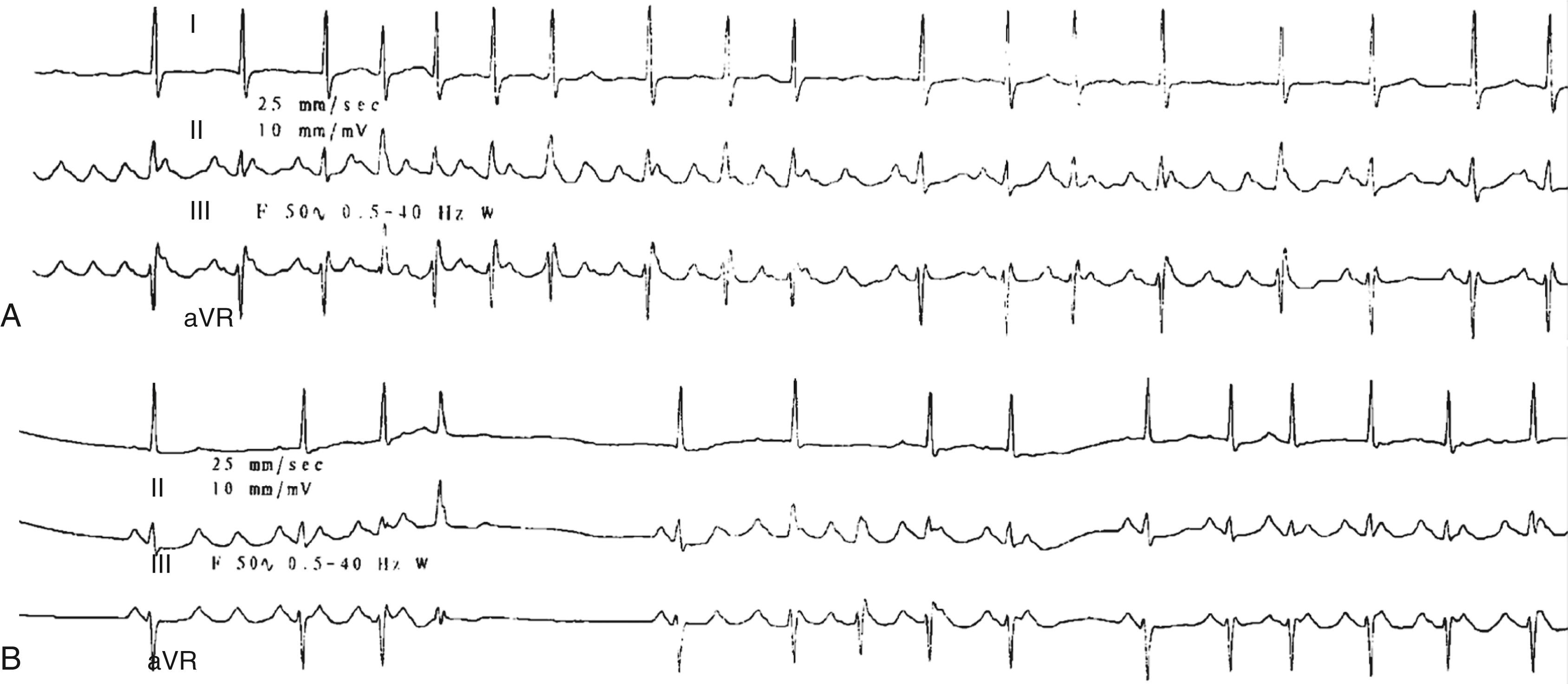 FIGURE 65.3, A, This rhythm strip resembles atrial flutter with continuous P wave undulation. However, on closer inspection, there is marked cycle length variability indicating that this is not macroreentry but rather likely to be focal. B, Spontaneous initiations and terminations of the arrhythmia confirming a focal mechanism related either to abnormal automaticity or triggered automaticity. This pattern is incompatible with a reentrant arrhythmia.