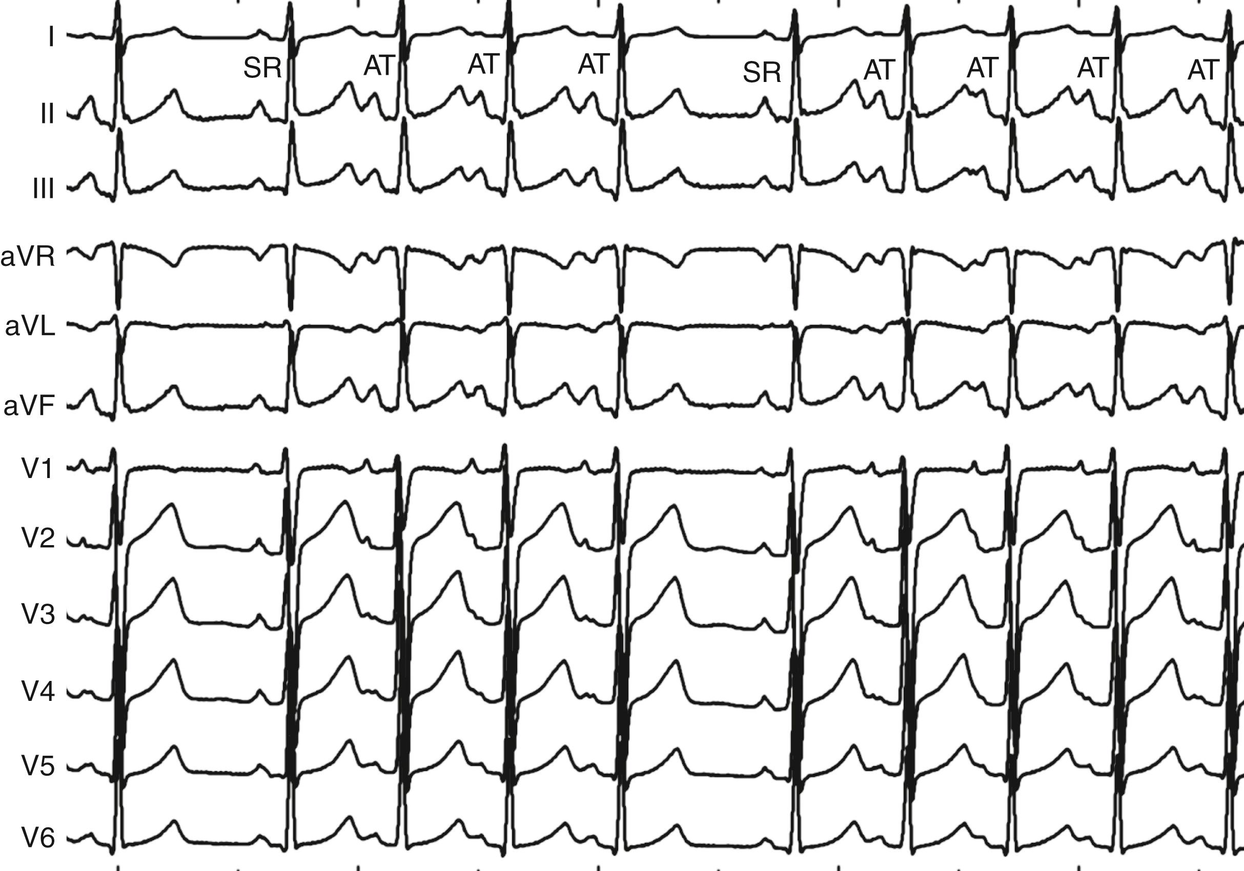 FIGURE 65.4, Continuous 12-lead ECG indicating short bursts of atrial tachycardia from the region of the superior crista terminalis. Note that the P wave morphology of the tachycardia beats (atrial tachycardia [AT]) is very similar to the morphology of the sinus beats (SR).