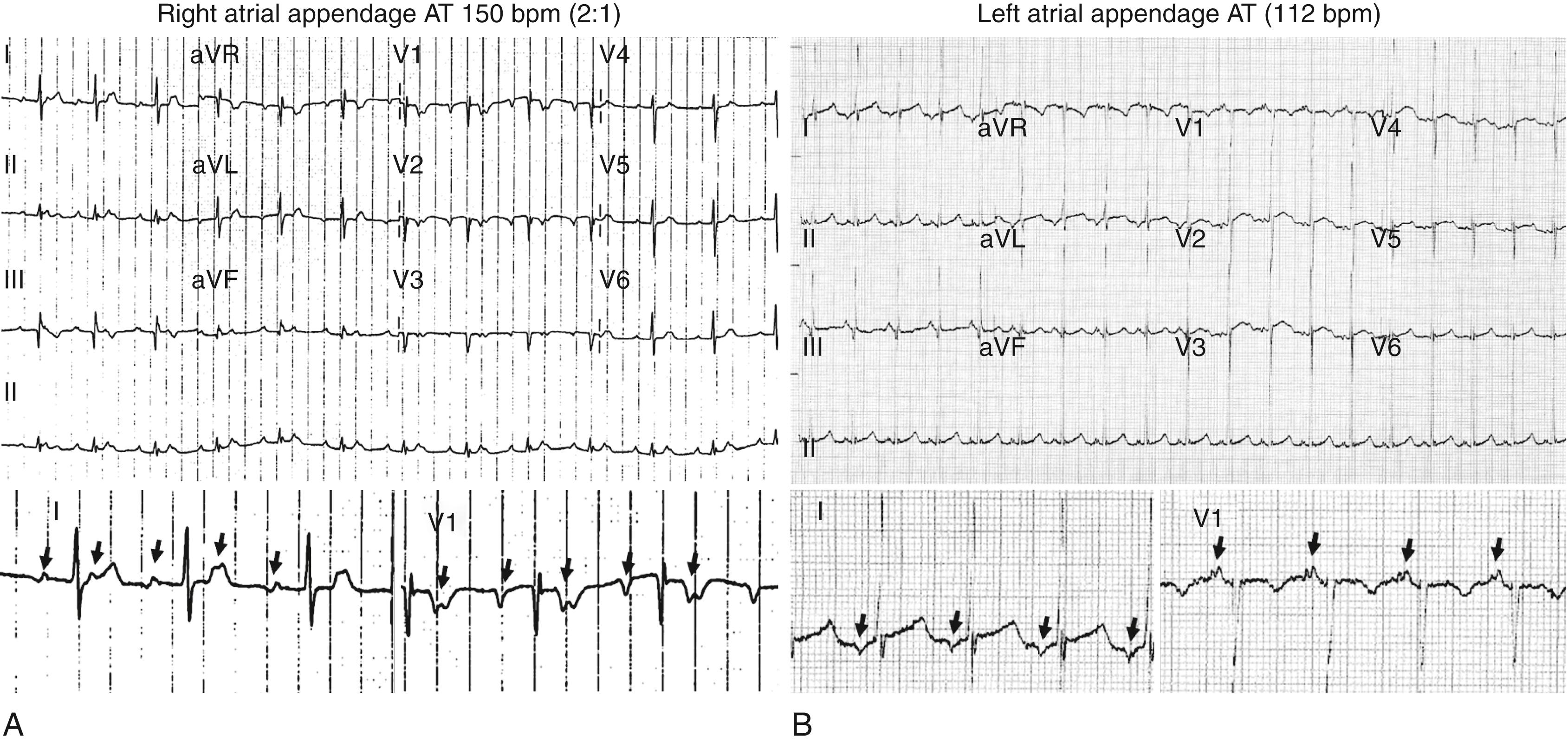 FIGURE 65.5, A, A 12-lead ECG of an incessant tachycardia originating in the right atrial appendage. The atrial rate is 150 bpm, and there is 2:1 conduction to the ventricle. The P wave is deeply inverted from V 1 to V 3 consistent with an origin in the right atrial appendage (anterior location), and lead I has an unusual biphasic negative-positive appearance inconsistent with a sinus origin. B, A 12-lead ECG of an incessant tachycardia originating in the left atrial appendage. The P wave morphology is characteristic, showing a broad upright and notched appearance in V 1 , a similar pattern in inferior leads (especially well seen in aVF) and a deeply inverted pattern in lead I (characteristic for a left appendage origin). The incessant tachycardia at 112 bpm did not produce symptomatic palpitations, but the patient presented with heart failure due to tachycardia-mediated cardiomyopathy that was reversed after successful ablation.