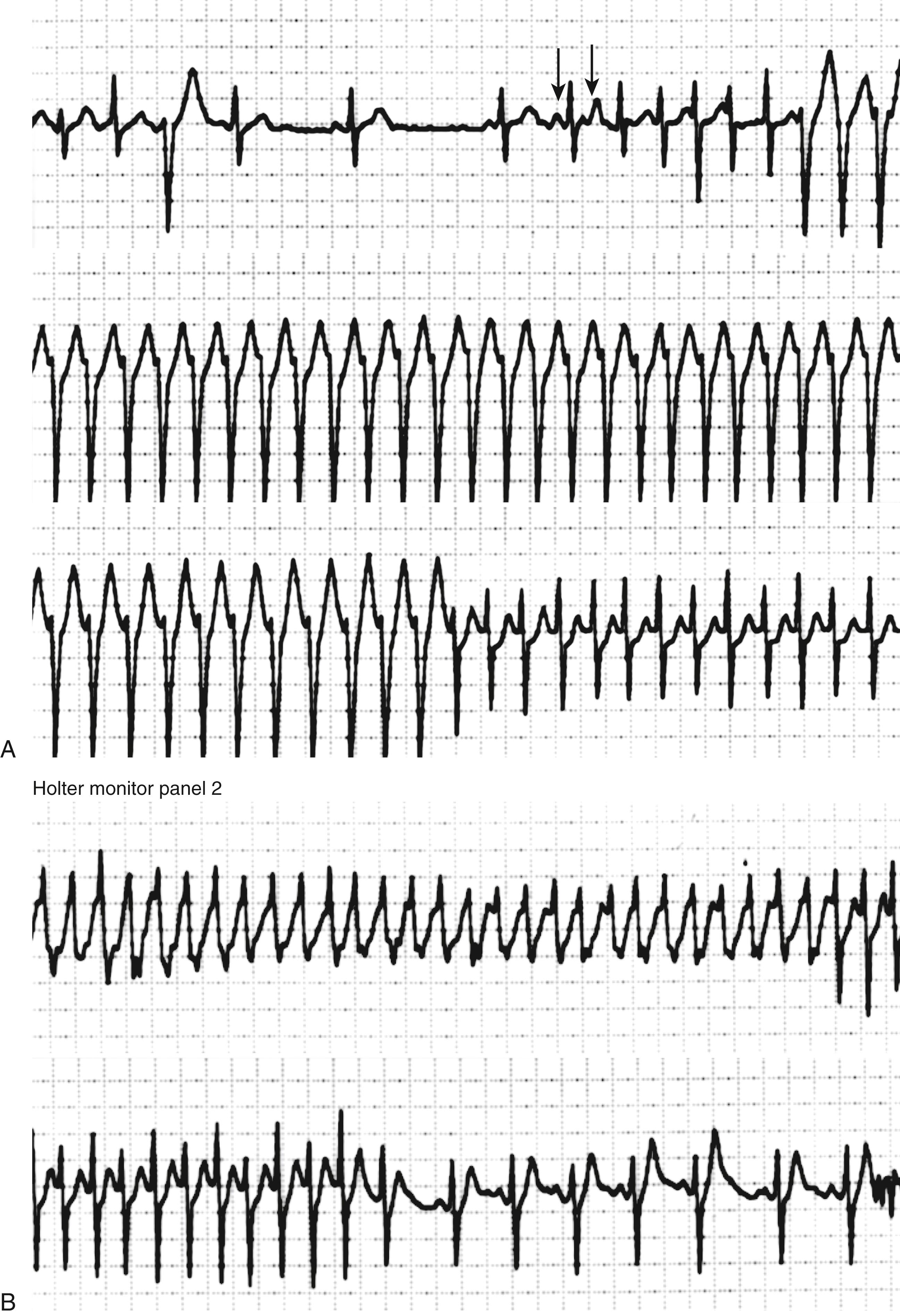 EFIGURE 65.1, Holter monitor recordings of 17-year-old female patient with a structurally normal heart and recurrent palpitations, presyncope, and syncope.
