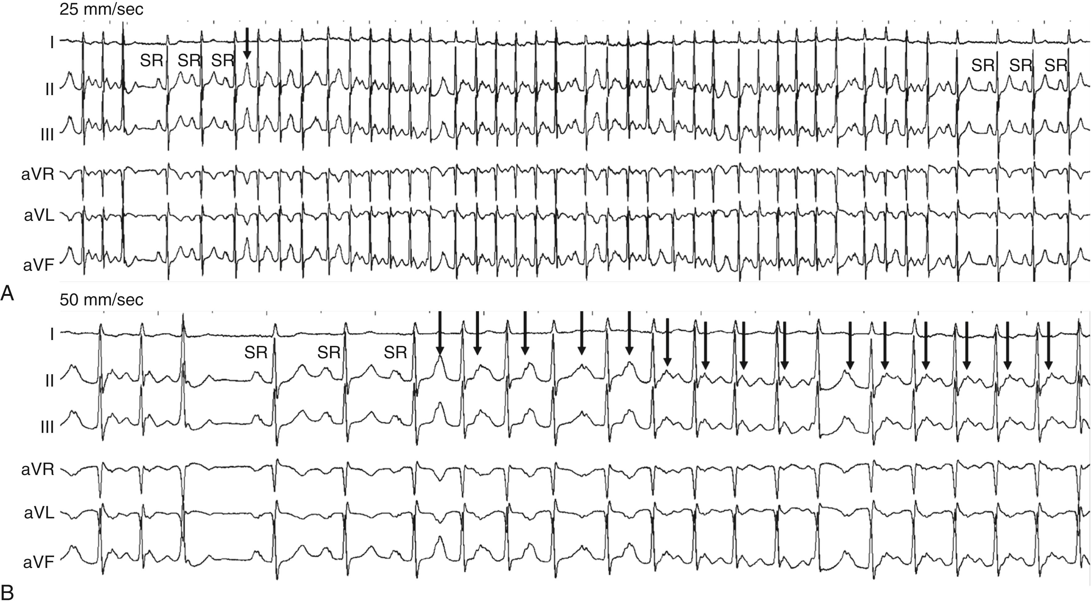 FIGURE 65.6, A, Continuous ECG at a sweep speed of 25 mm/sec; on the left there is termination of an arrhythmia followed by 3 sinus beats (SR) before onset of a rapid irregular tachycardia with a P wave on the peak of the T wave ( arrow ) . At first glance this trace suggests atrial fibrillation. The arrhythmia terminates spontaneously on the right of the trace. B, The tachycardia initiation is shown at a faster sweep speed (50 mm/sec). It is now possible to see the P wave deforming the T wave and the tail end of the QRS throughout the burst of tachycardia ruling out atrial fibrillation. Because the P wave shows variable fusion with the T wave it is possible to think there is variation in morphology that would suggest a multifocal atrial tachycardia. In fact this was a single-focus atrial tachycardia arising in the left atrial roof.