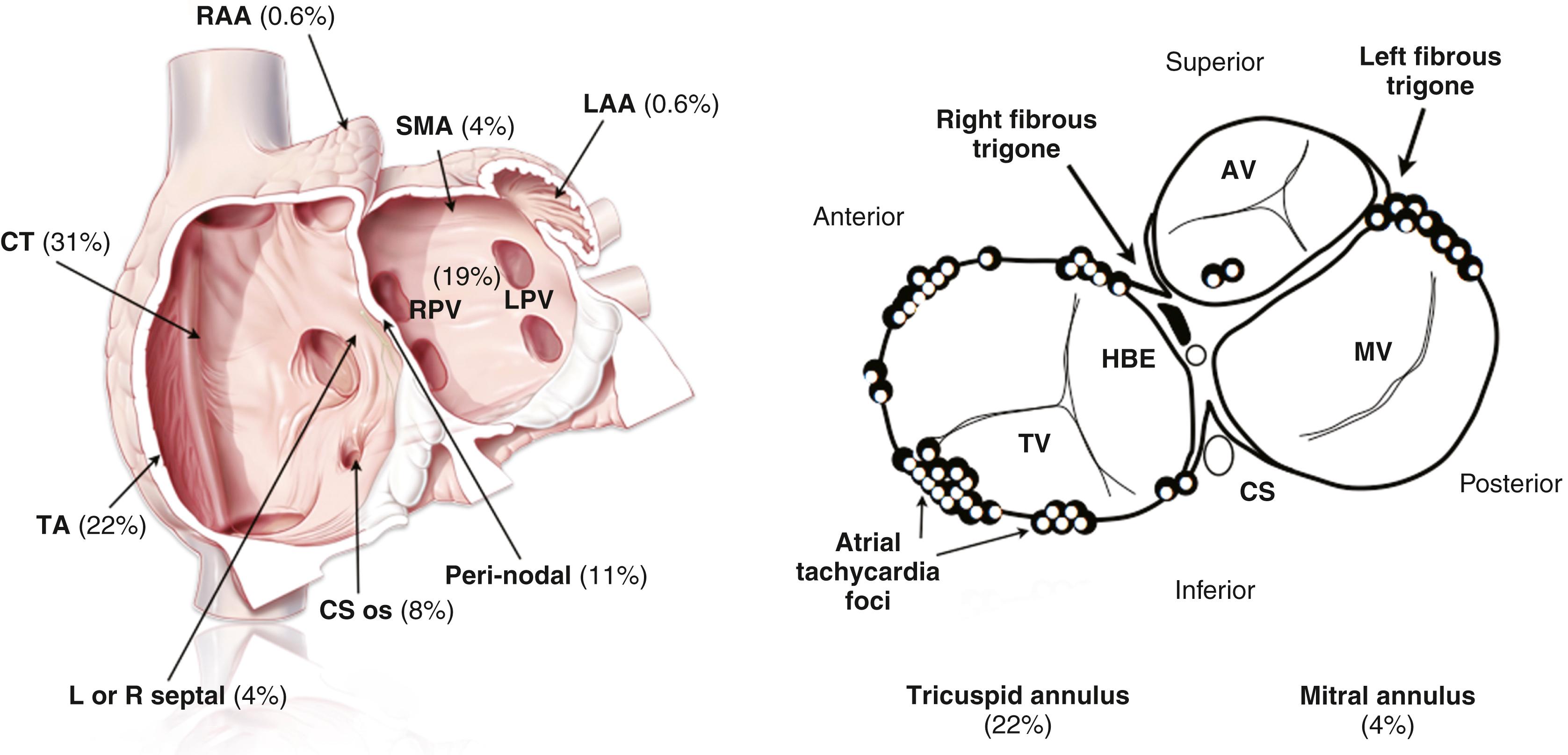 FIGURE 65.7, Anatomic distribution of focal atrial tachycardias.