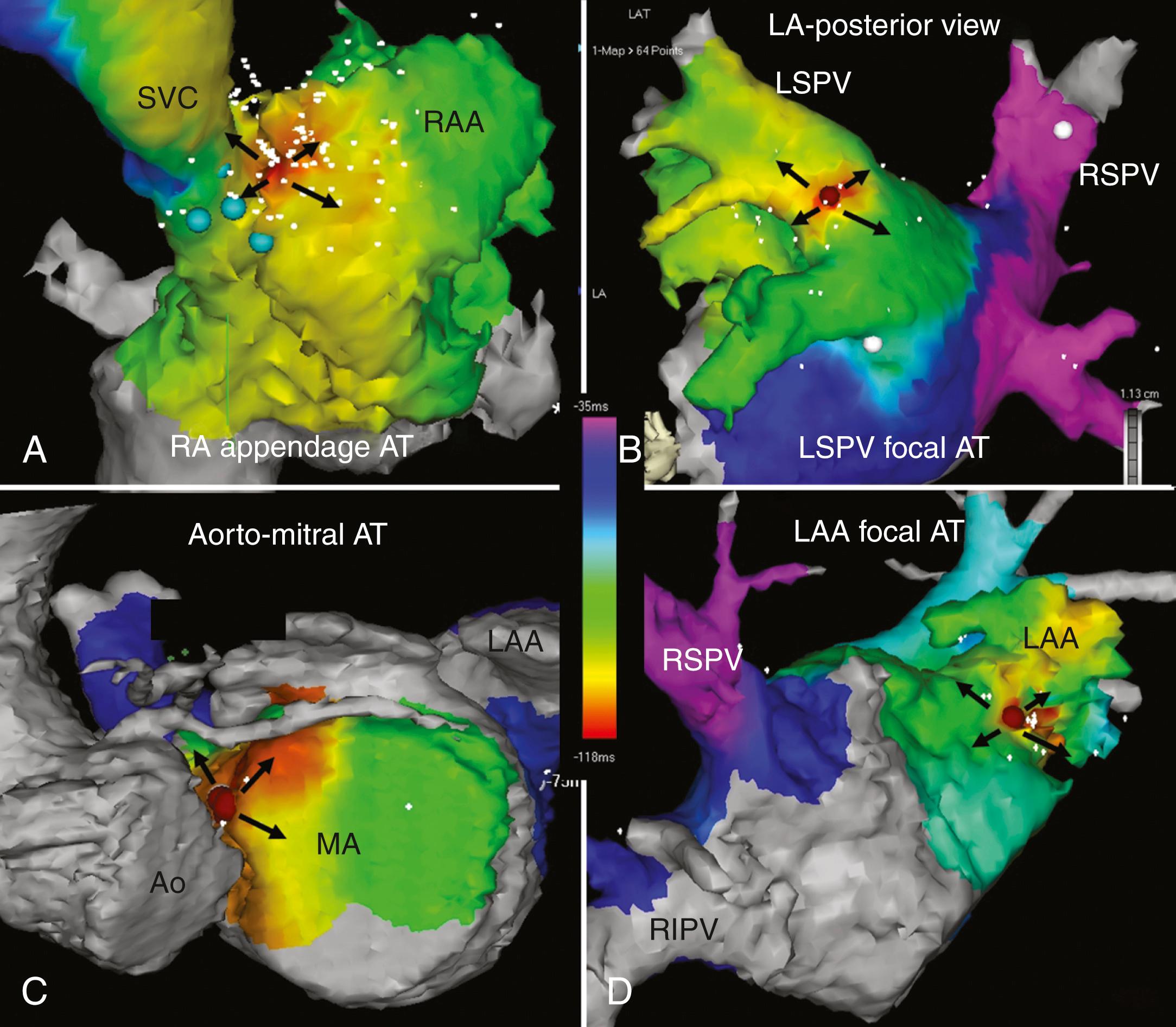 FIGURE 65.8, Three-dimensional electroanatomic maps of focal atrial tachycardia originating from four different anatomic locations. The earliest site of activation is represented by red, with yellow, green, light blue, dark blue, and purple representing progressively later activation. The black arrows indicate centrifugal spread away from the site of focal origin where ablation was successful in eliminating the tachycardia. A, Origin at the superior base of the right atrial appendage (RAA). B, Origin from the posterior inferior ostium of the left superior pulmonary vein. C, Origin from the aortomitral continuity. D, Origin from the anterior base of the left atrial appendage (LAA). Ao, Aortic root; LA, left atrium; LSPV, left superior pulmonary vein; MA, mitral annulus; RIPV, right inferior pulmonary vein; RSPV, right superior pulmonary vein; SVC, superior vena cava.