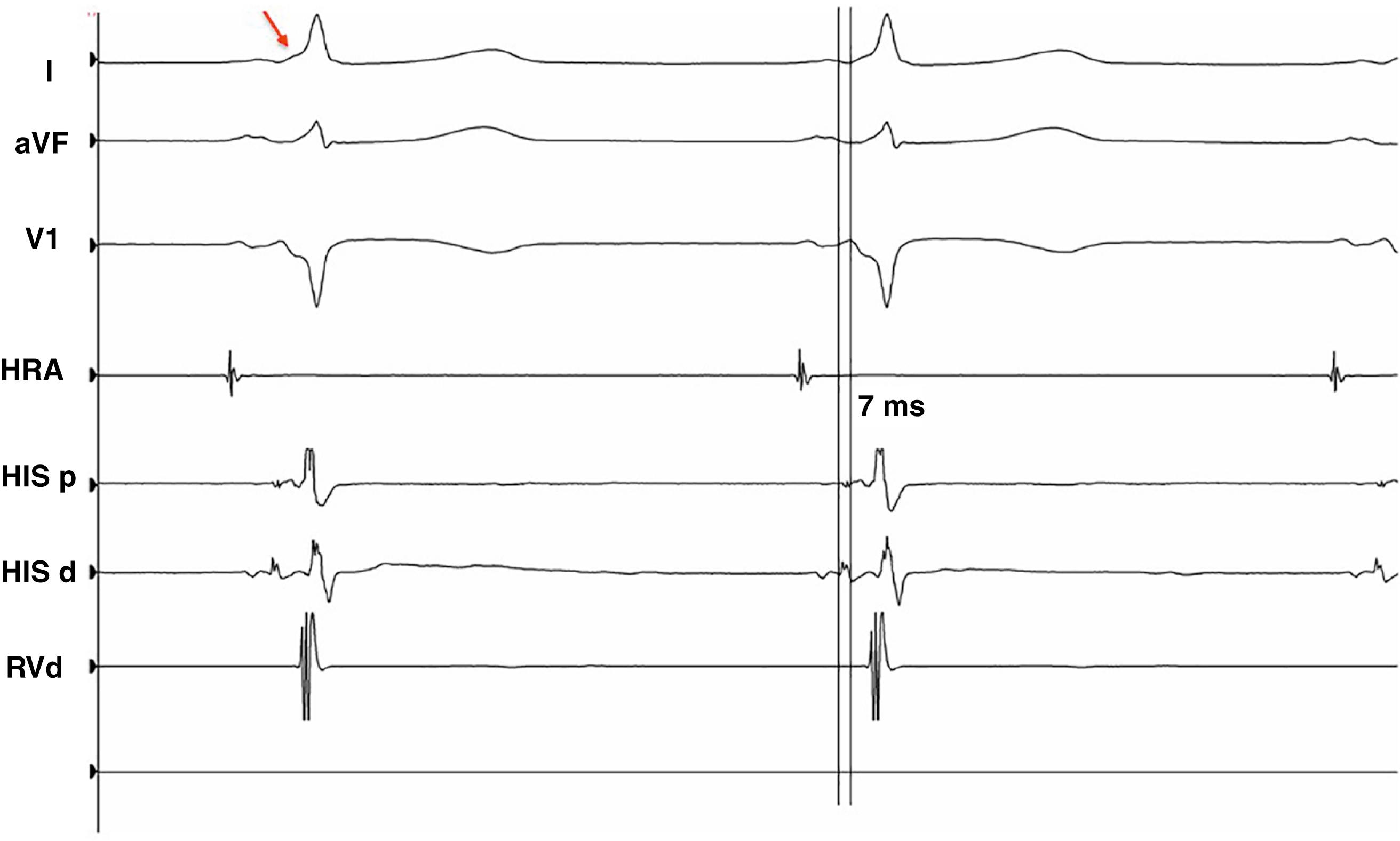 Fig. 70.2, Baseline observations: His to earliest ventricular activation (HV) time.