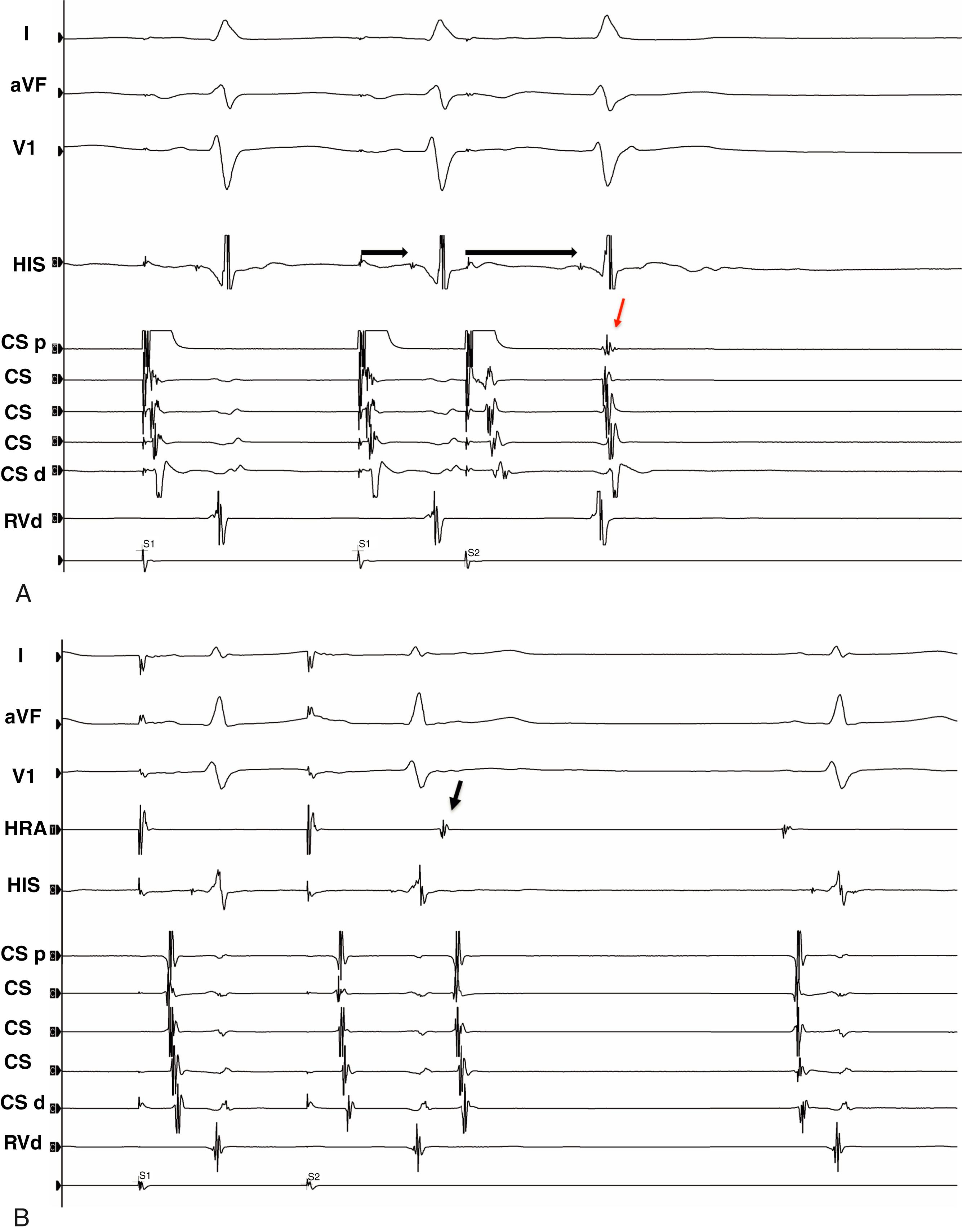 Fig. 70.3, (A) Typical atrioventricular (AV) nodal echo beat. An atrial extrastimulus from the proximal CS (third stimulus) results in a relatively long AH interval (antegrade slow pathway conduction, black arrows ), ventricular activation, followed by immediate atrial activity (red arrow) with a short VA time consistent with an AV nodal echo beat, resulting from retrograde fast pathway conduction. This is evidence for dual AV nodal physiology and makes a diagnosis of atrioventricular reentrant tachycardia likely. (B) Atypical accessory pathway echo beat. An atrial extrastimulus is delivered from the high right atrium (HRA), resulting in decremental antegrade conduction in the AV node, followed by ventricular activation and atrial electrograms, which are earliest in the HRA catheter (black arrow). Retrograde conduction cannot have been AV nodal, as CS activation would have preceded HRA activation. This finding is consistent with the presence of a right-sided action potential.