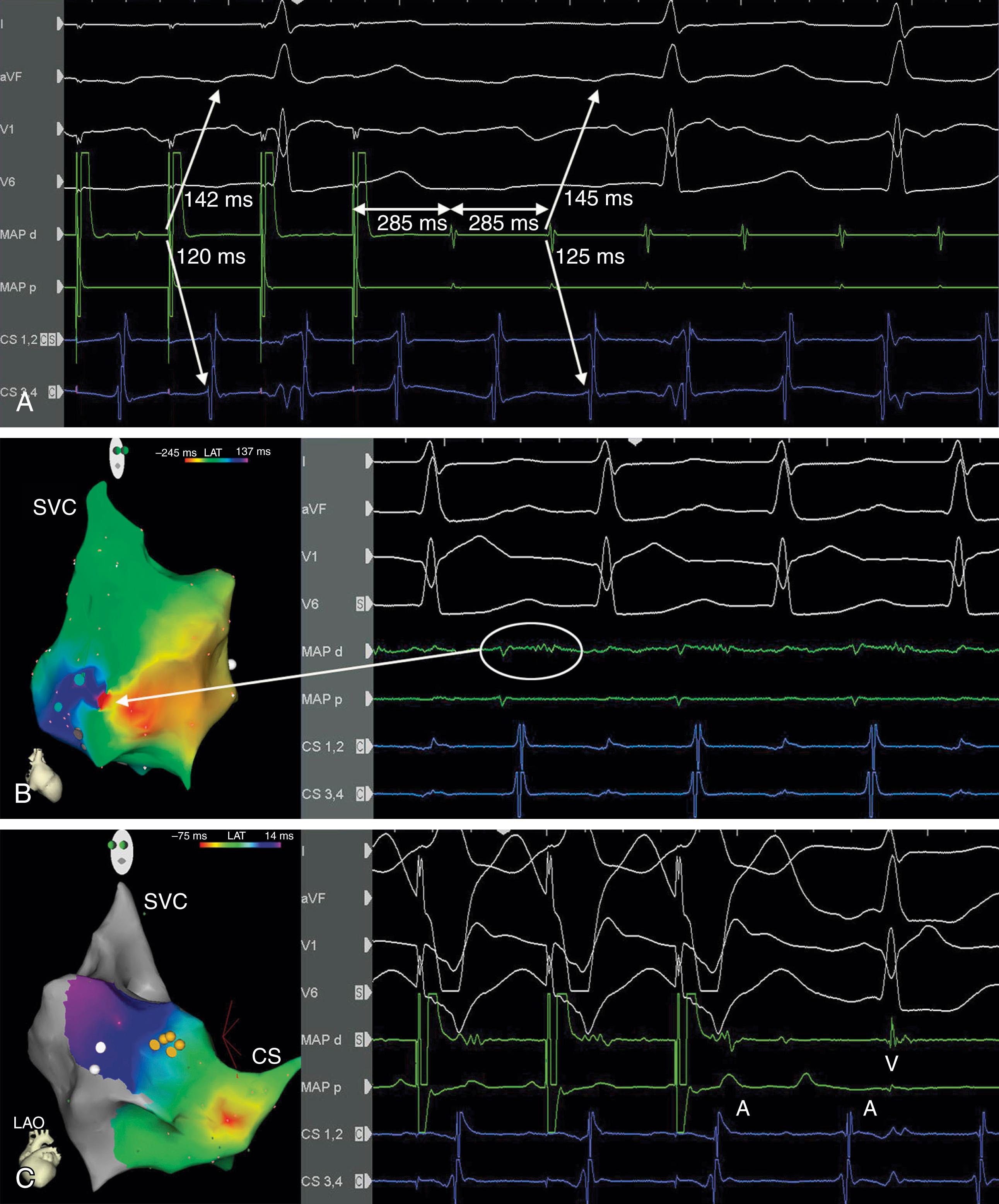 Fig. 115.1, Arrhythmia mechanisms in tetralogy of Fallot.