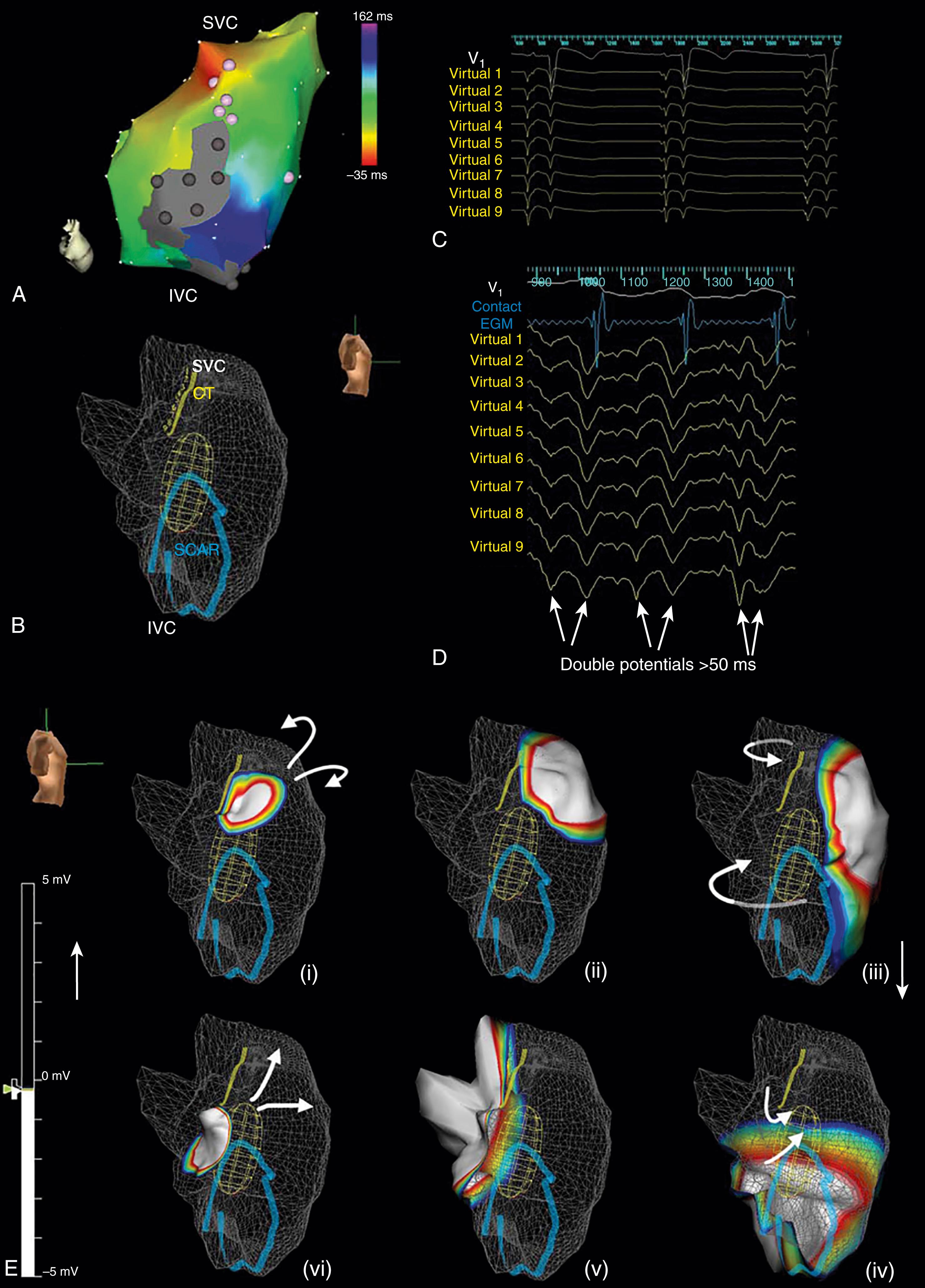 Fig. 115.2, Functional conduction block at the crista terminalis (CT) supporting macroreentry tachycardia in the atriopulmonary Fontan.