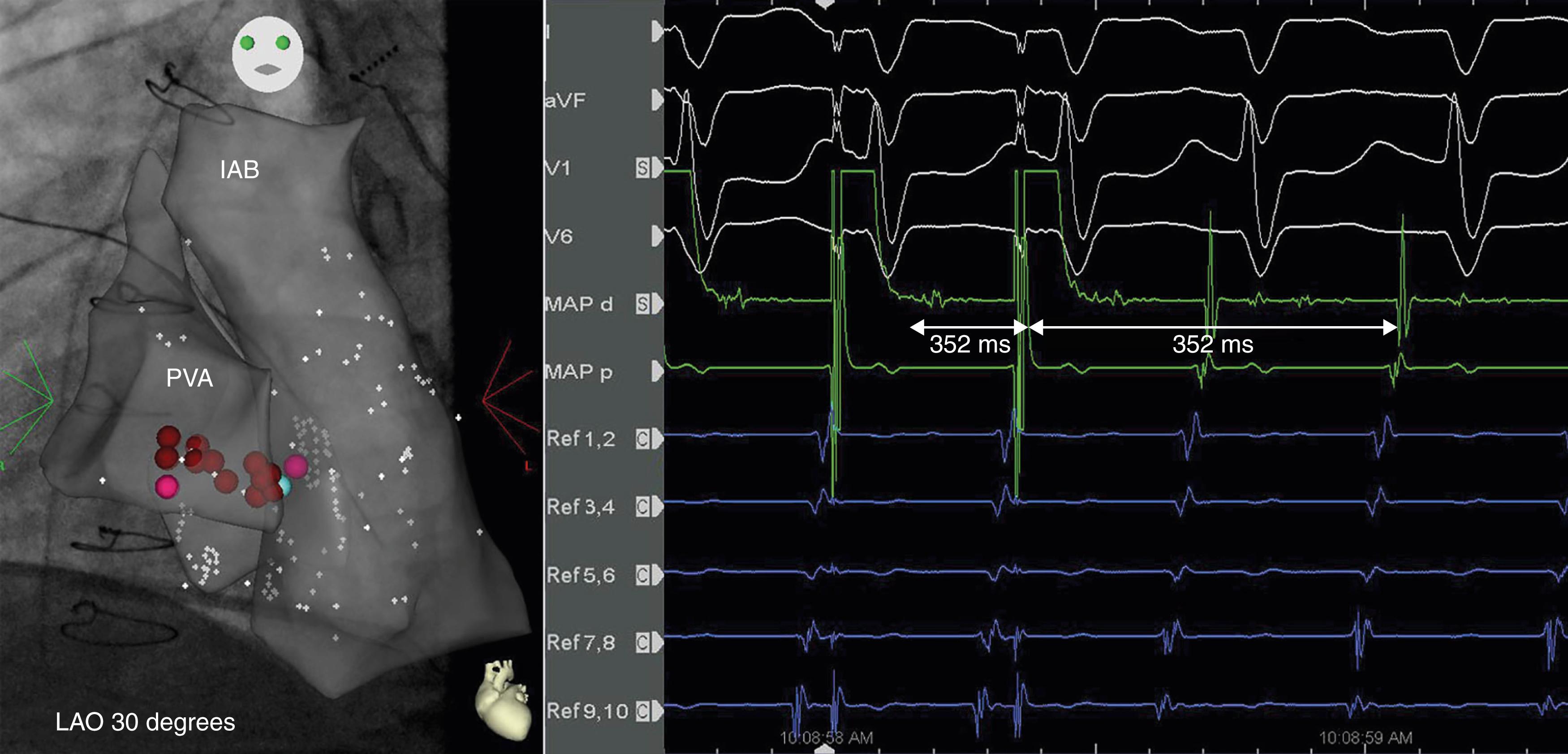 Fig. 115.3, Entrainment and ablation at the cavomitral isthmus in a patient after total cavopulmonary connection.