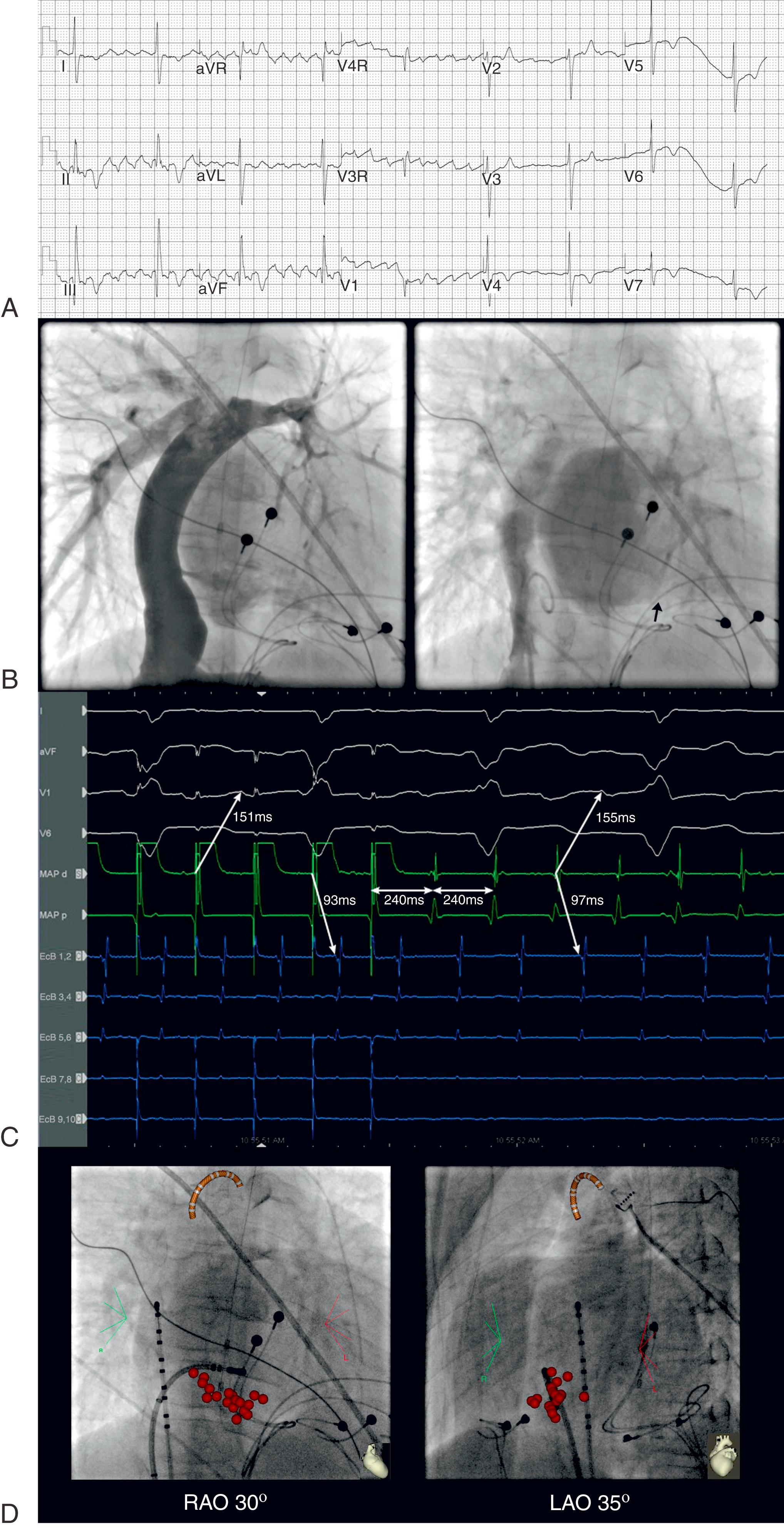 Fig. 115.5, Cavomitral isthmus dependent atrial flutter after extracardiac total cavopulmonary connection.