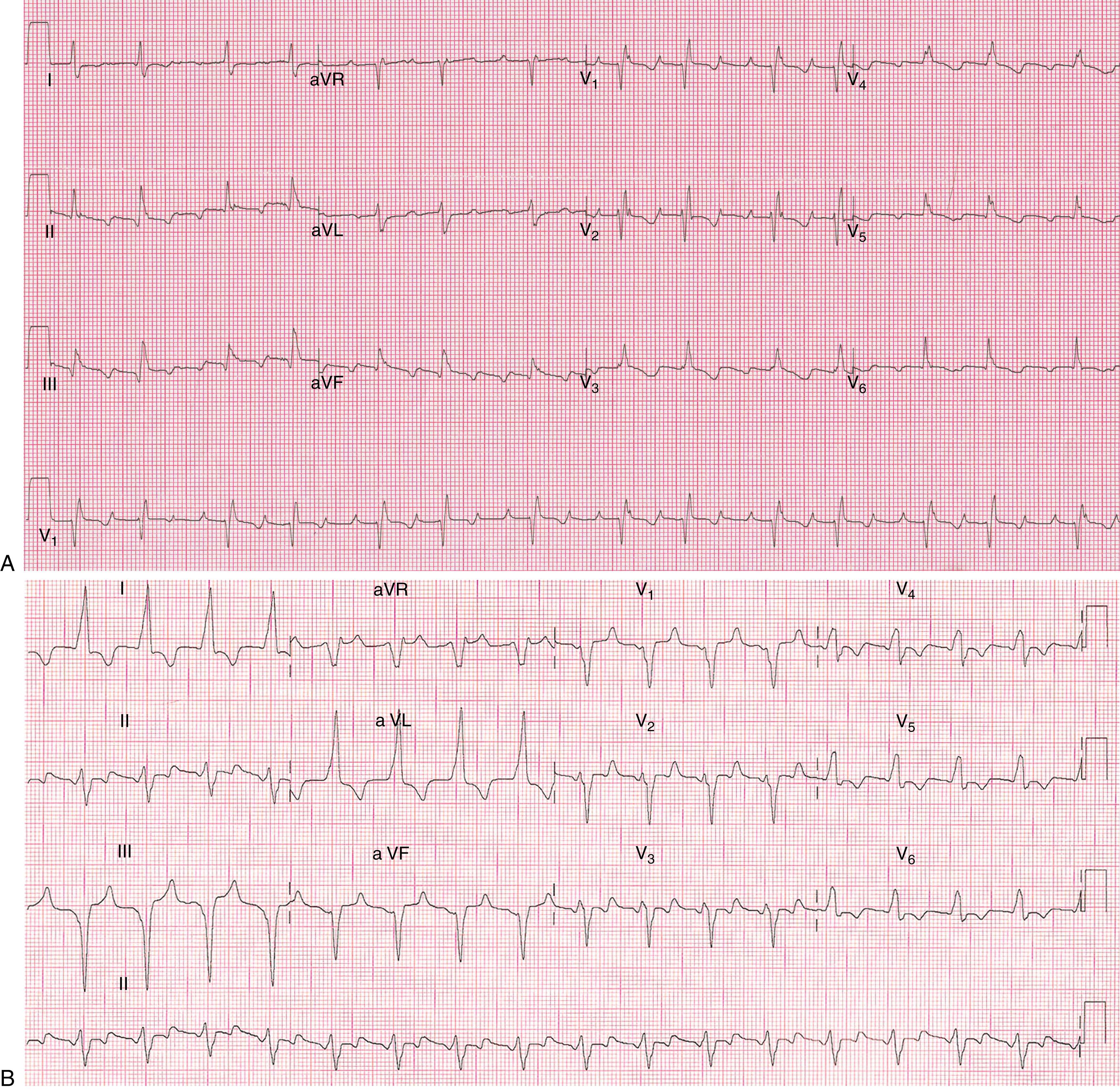 Fig. 115.6, Electrocardiograms in Ebstein anomaly demonstrating atrial flutter.