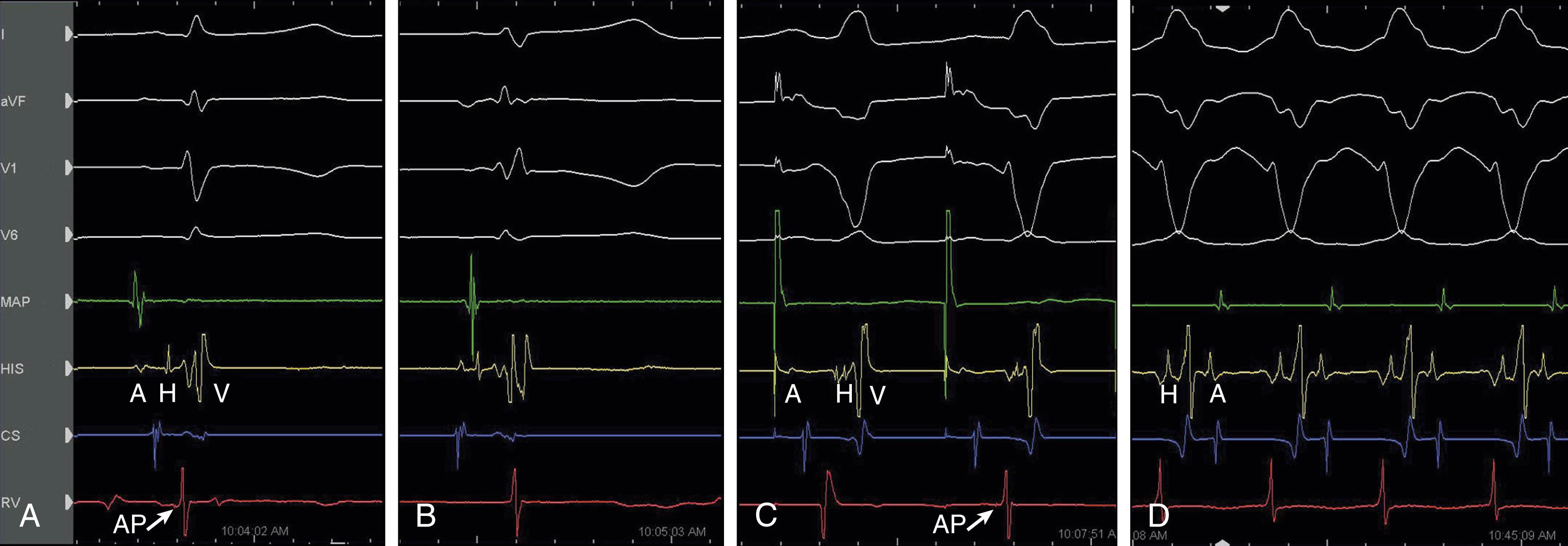 Fig. 115.7, Variable QRS morphologies in Ebstein anomaly resulting from an atriofascicular fiber.