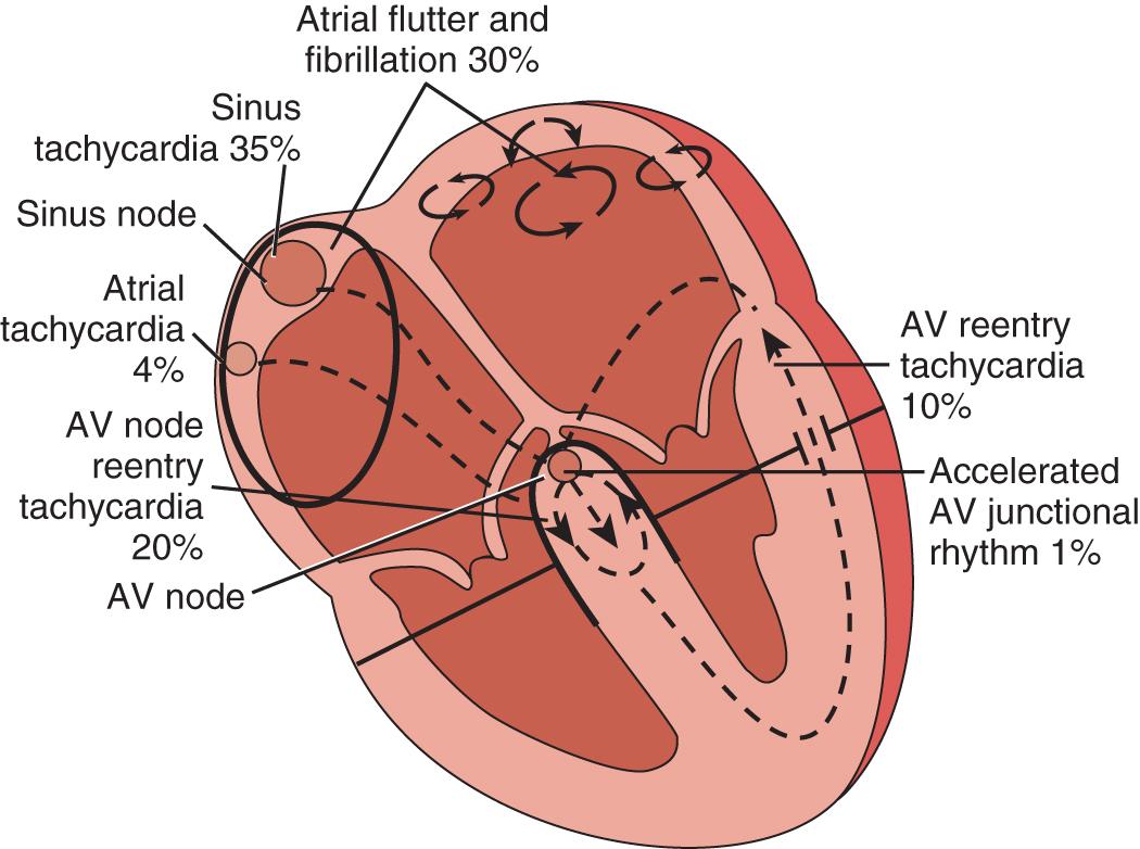 Fig. 71.1, Supraventricular tachyarrhythmias encountered in the emergency setting.