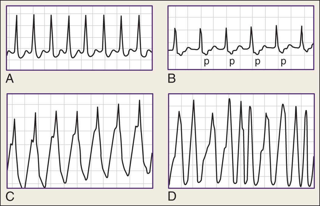 Fig. 71.4, A, Atrioventricular nodal reentry tachycardia, slow-fast type. Note narrow QRS complexes and absence of P waves. B, Atrioventricular reentry orthodromic tachycardia. Retrograde inverted P waves follow QRS complexes in leads II, III, and aVF. C, Atrioventricular reentry antidromic tachycardia with wide QRS complexes. Electrocardiogram during sinus rhythm with a QRS complex morphology identical to that seen during tachycardia may be helpful in the diagnosis. D, Atrial fibrillation in preexcitation syndrome with a fast ventricular rate response.