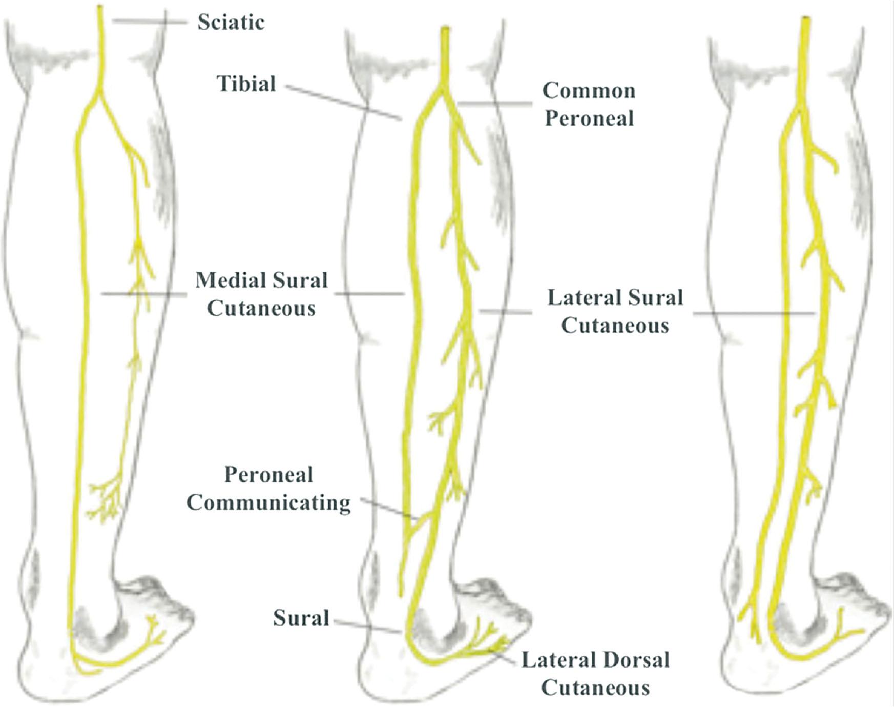 Figure 30.1, Variations of the anatomy of the sural nerve.